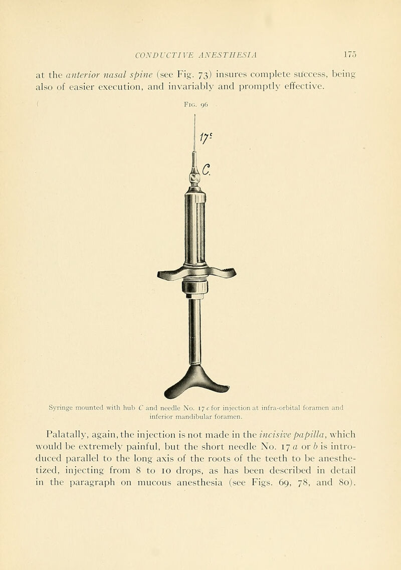 at ihf (Ulterior nasal spine (see Fig. jt,) insures complete success, being also of easier execution, and invariably and prom])th' effective. ; Fig. go Syringe mounted with hub C and needle No. i ye for injection at infra-orbital foramen and inferior mandibular foramen. Palatally, again, the injection is not made in the incisive papilla, which would be extremely painful, but the short needle No. ij a or b is intro- duced parallel to the long axis of the roots of the teeth to be anesthe- tized, injecting from 8 to lo drops, as has been described in detail in the paragraph on mucous anesthesia (see Figs. 69, /S, and So).