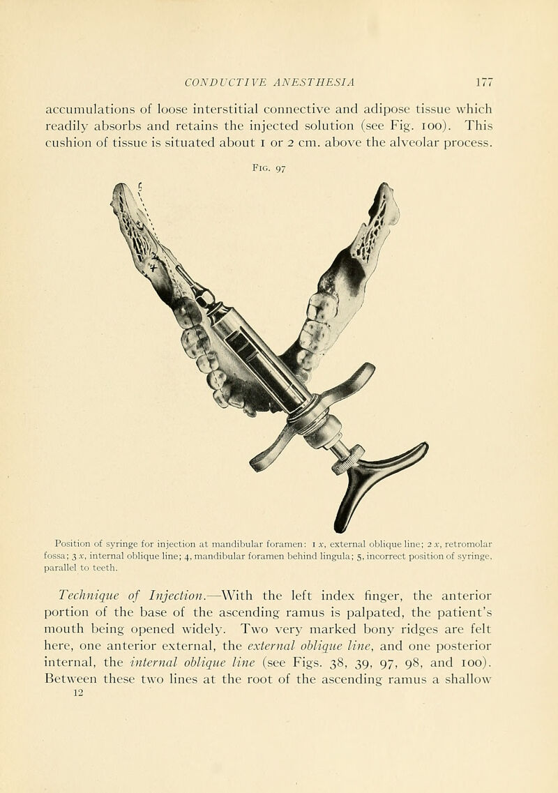 accumulations of loose interstitial connective and adipose tissue which readily absorbs and retains the injected solution (see Fig. lOo). This cushion of tissue is situated about i or 2 cm. above the alveolar process. Fig. 97 Position of syringe for injection at mandibular foramen: i .v, external oblique line; 2 x, retromolar fossa; 3 X, internal oblique line; 4, mandibular foramen behind lingula; 5, incorrect position of syringe, parallel to teeth. Technique of Injection.—With the left index finger, the anterior portion of the base of the ascending ramus is palpated, the patient's mouth being opened widely. Two very marked bony ridges are felt here, one anterior external, the external oblique line, and one posterior internal, the internal oblique line (see Figs. 38, 39, 97, 98, and 100). Between these two lines at the root of the ascending ramus a shallow 12