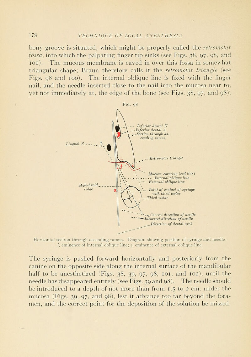 bony groove is situated, which might be properly called the retromolar fossa, into which the palpating finger tip sinks (see Figs. 38, 97, 98, and 101). The mucous membrane is caved in over this fossa in somewhat triangular shape; Braun therefore calls it the retromolar triangle (see Figs. 98 and 100). The internal oblique line is fixed with the finger nail, and the needle inserted close to the nail into the mucosa near to, yet not immediately at, the edge of the bone (see Figs. 38, 97, and 98)'. Lingual N. - Inferior dental iV. _ -Inferior dental A. ^..Section fhroutih as- cending ramus ■Fetromolar triangle Mucous covering {red line) - ■ ■ Internal oblique line External oilique line -Point of contact of syringe n-ith third molar Third molar ^--^,C'on-ec( direction of needle ^Incorrect directimi of needle Direction of dental arch Horizontal section through ascending ramus. Diagram showing position of syringe and needle: i, eminence of internal oblique line; e, eminence of external oblique line. The syringe is pushed forward horizontally and posteriorly from the canine on the opposite side along the internal surface of the mandibular half to be anesthetized (Figs. 38, 39, 97, 98, lOi, and 102), until the needle has disappeared entirely (see Figs. 39 and 98). The needle should be introduced to a depth of not more than from 1.5 to 2 cm. under the mucosa (Figs. 39, 97, and 98), lest it advance too far beyond the fora- men, and the correct point for the deposition of the solution be missed.