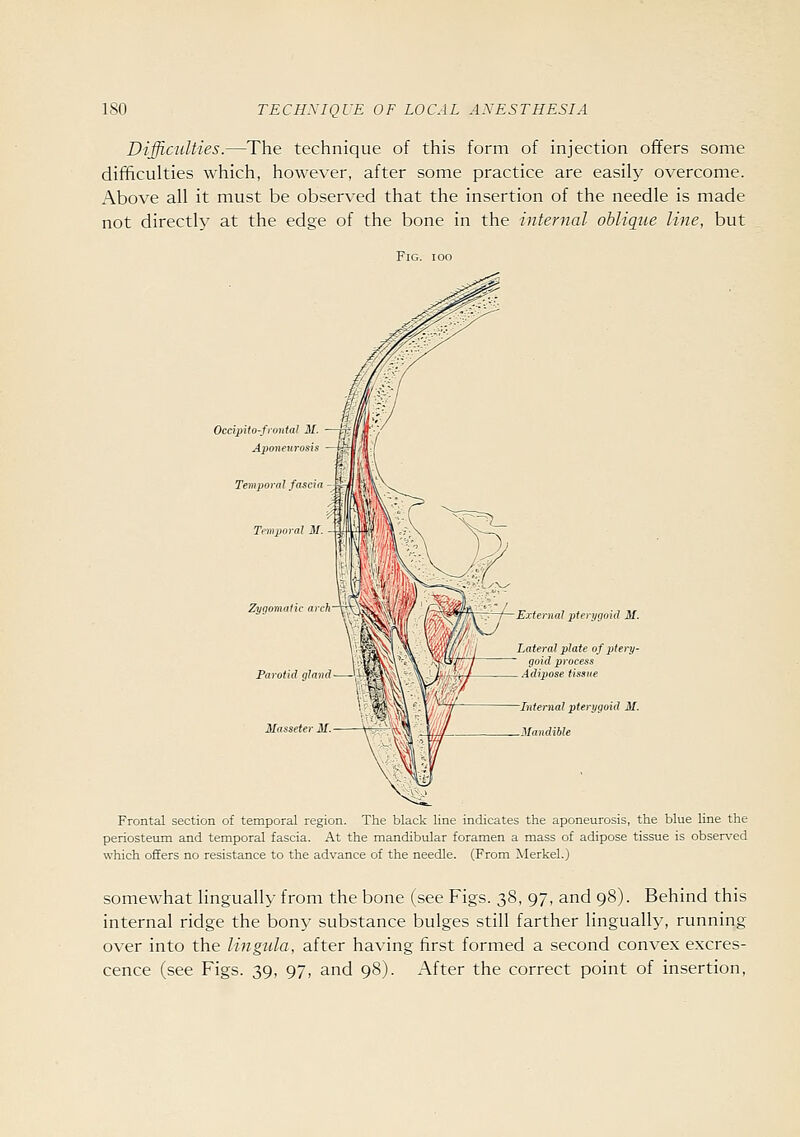 Difficulties.—The technique of this form of injection offers some difficulties which, however, after some practice are easily overcome. i\bove all it must be observed that the insertion of the needle is made not directh' at the edge of the bone in the inteynal oblique line, but Occipito-frontal M Aponeta osis Zygomatic atcli~T' \*v i Parotid almtd 'J Massetei M — •^1 \ ^—External pienigoid M. Lateral plate of ptery- qoid process idipose tissue Internal pterygoid M. Mandible Frontal section of temporal region. The black line indicates the aponeurosis, the blue line the periosteum and temporal fascia. At the mandibular foramen a mass of adipose tissue is observed which offers no resistance to the advance of the needle. (From Merkel.) somewhat lingually from the bone (see Figs. 38, 97, and 98). Behind this internal ridge the bony substance bulges still farther lingually, running over into the lingula, after having first formed a second convex excres- cence (see Figs. 39, 97, and 98). After the correct point of insertion.