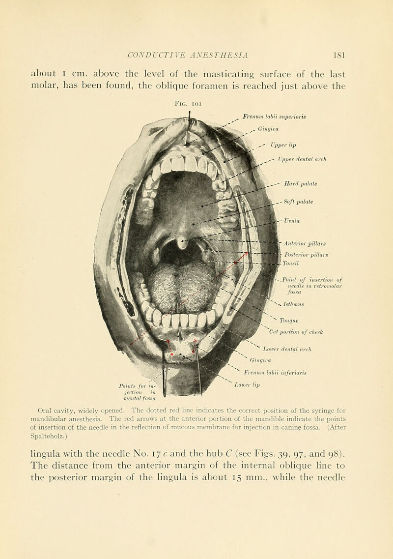 about I cm. above the level of the masticating surface of the last molar, has been found, the oblique foramen is reached just above the TT^ ..-'^%^ t-:-:. ^ Freuum liibii superioris Ik''' iifiiva &..'- Upper lip ; 1 ^,-- Cpper dental arch i %^1 __'- Hard palate C m i Wk^- Soft palate t m\f{ ^■^ Uvula rFJ ^^m Anterior pillars l>li^ ^^/b Posteriur pillars K:rj ^m.To„sii W/f;'M tB>-^Point of insertion of ^ifl IV needle in retromolar H fossa ? i ' ^^ Isthmus f ^ Tongue M Cnl portion of cheek r^-- ^ ^ Loiver dental arch ^ f^innJ Lrntgi la Frenmn labii inferioris Lo wer lip Oral cavity, widely opened. The dotted red line indicates the correct position of the syringe for mandibular anesthesia. The red arrows at the anterior portion of the mandible indicate the points of insertion of the needle in the reflection of mucous membrane for injection in canine fossa. (After Spalteholz.) lingula with the needle No. 17 c and the hub C (see Figs. 39, 97, and 98). The distance from the anterior margin of the internal oblique line to the posterior margin of the lingula is about 15 mm., while the needle