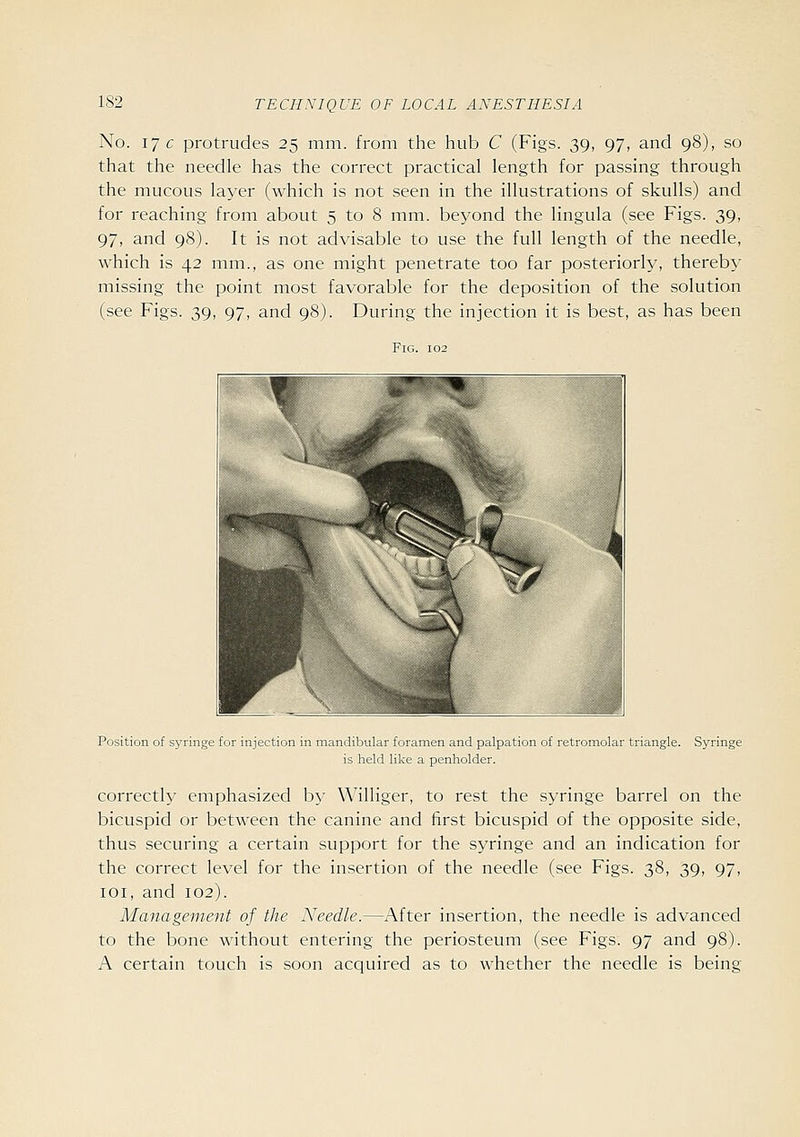 No. 17 c protrudes 25 mm. from the hub C (Figs. 39, 97, and 98), so that the needle has the correct practical length for passing through the mucous layer (which is not seen in the illustrations of skulls) and for reaching from about 5 to 8 mm. beyond the lingula (see Figs. 39, 97, and 98). It is not advisable to use the full length of the needle, which is 42 mm., as one might penetrate too far posteriorly, thereby missing the point most favorable for the deposition of the solution (see Figs. 39, 97, and 98). During the injection it is best, as has been Position of syringe for injection in mandibular foramen and palpation of retromolar triangle. Syringe is held like a penholder. correctly emphasized by Williger, to rest the syringe barrel on the bicuspid or between the canine and first bicuspid of the opposite side, thus securing a certain support for the syringe and an indication for the correct level for the insertion of the needle (see Figs. 38, 39, 97, loi, and 102). Management of the Needle.—After insertion, the needle is advanced to the bone without entering the periosteum (see Figs. 97 and 98). A certain touch is soon acquired as to whether the needle is being