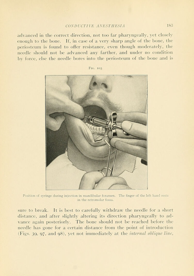 acK-anced in the correct direction, not too far pharyngeally, \'et closeh' enough to the bone. If, in case of a very sharp angle of the bone, the periosteum is found to ofifer resistance, even though moderately, the needle should not be advanced any farther, and under no condition by force, else the needle bores into the periosteum of the bone and is Fig. 103 Position of syringe during injection in mandibular foramen. The finger of the left hand rests in the retromolar fossa. sure to break. It is best to carefully withdraw the needle for a short distance, and after slightly altering its direction pharyngeal!}- to ad- vance again posteriorly. The bone should not be reached before the needle has gone for a certain distance from the point of introduction (Figs. 39, 97, and 98), yet not immediately at the internal oblique line.
