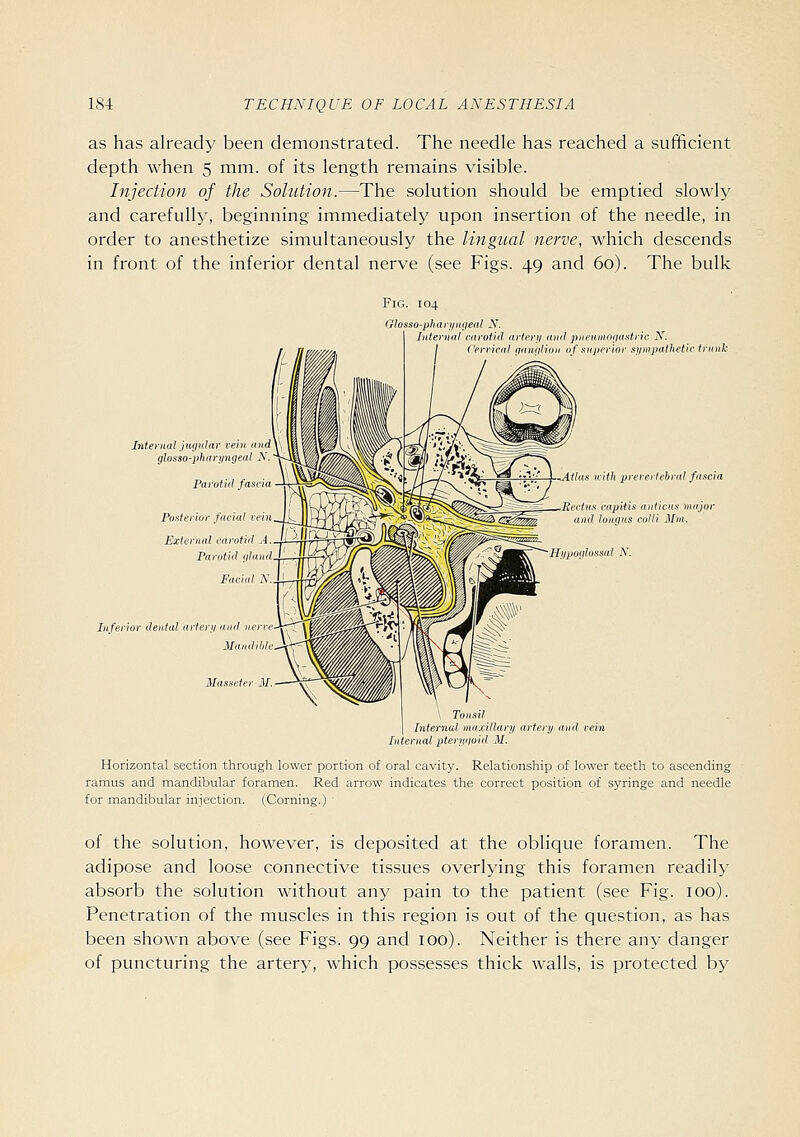 as has already been demonstrated. The needle has reached a sufficient depth when 5 mm. of its length remains visible. Injection of the Solution.—The solution should be emptied slowly and carefully, beginning immediately upon insertion of the needle, in order to anesthetize simultaneously the lingual nerve, which descends in front of the inferior dental nerve (see Figs. 49 and 60). The bulk Fig. 104 Glosso-phaii/iHieal X. rotid nrtrrji and pneumorjastric N. ^rririi! iiinniHun tif superior si/uipathetic iriinh Interna} < Internal jugular vein and glosso-pharyngeal N. Parotid fascia Posterior facial rein External carotid A.. Parotid gland. Facial N.. Inferior dental arteri/and nerrC' Mandible -Atlas u-itli prerertebral fascia Rectus eapiiis anticus m Qf-^^K and longus colli Mm. Hi/poglossal N. \ Tonsil Internal maxillary artery and vein Internal pteritiioid M. Horizontal section through lower portion of oral cavity. Relationship of lower teeth to ascending ramus and mandibular foramen. Red arrow indicates the correct position of syringe and needle for mandibular injection. (Corning.) of the solution, however, is deposited at the oblique foramen. The adipose and loose connective tissues overlying this foramen readily absorb the solution without any pain to the patient (see Fig. 100). Penetration of the muscles in this region is out of the question, as has been shown above (see Figs. 99 and 100). Neither is there any danger of puncturing the artery, which possesses thick walls, is protected by