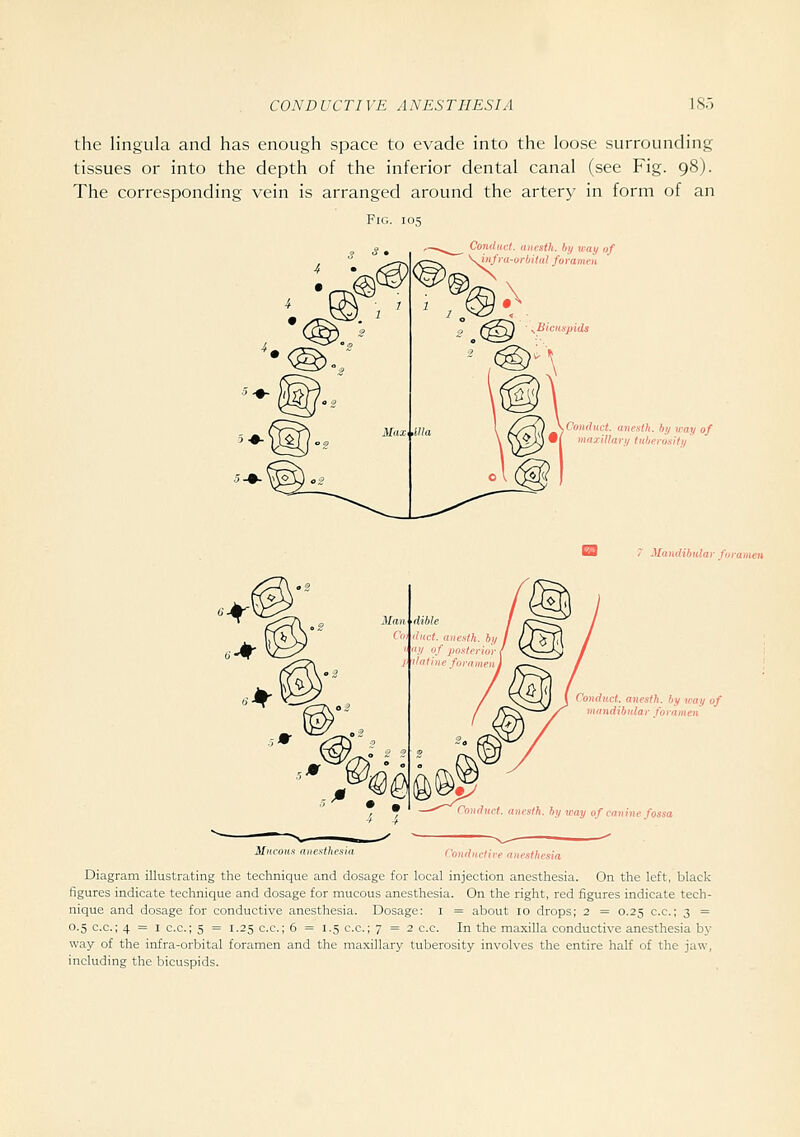 tlic lingula and has enough space to evade into the loose surrounding tissues or into the depth of the inferior dental canal (see Fig. 98). The corresponding vein is arranged around the artery in form of an Fig. 105 Conilimt. aiiesth. hy way of ' infra-urbilul foramen Conduct, anesth. by way of • 1 maxillary tnherosify Manilihidar foraii Conduct, anesth. by way of mandibular foramen Conduct, aneslh. hy way of canine fossa Miicou Conduct ire anestliciia Diagram illustrating the technique and dosage for local injection anesthesia. On the left, black figures indicate technique and dosage for mucous anesthesia. On the right, red figures indicate tech- nique and dosage for conductive anesthesia. Dosage: i = about lo drops; 2 = 0.25 c.c; 3 = 0.5 c.c; 4 = 1 c.c; 5 = 1.25 c.c; 6 = 1.5 c.c; 7=2 c.c. In the maxilla conductive anesthesia by way of the infra-orbital foramen and the maxillary tuberosity involves the entire half of the jaw, including the bicuspids.