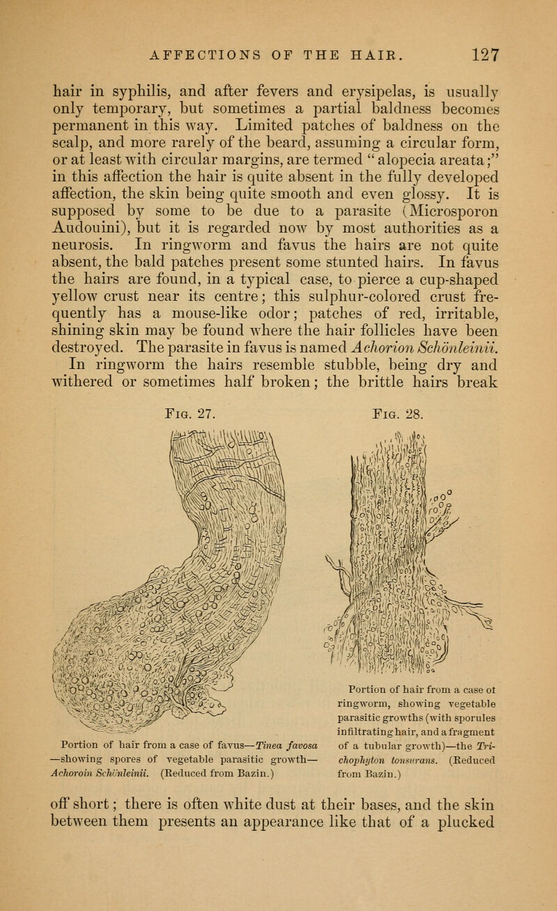 hair in syphilis, and after fevers and erysipelas, is usually only temporary, but sometimes a partial baldness becomes permanent in this way. Limited patches of baldness on the scalp, and more rarely of the beard, assuming a circular form, or at least with circular margins, are termed  alopecia areata; in this affection the hair is quite absent in the fully developed affection, the skin being quite smooth and even glossy. It is supposed by some to be due to a parasite (Microsporon Audouini), but it is regarded now by most authorities as a neurosis. In ringworm and favus the hairs are not quite absent, the bald patches present some stunted hairs. In favus the hairs are found, in a typical case, to pierce a cup-shaped yellow crust near its centre; this sulphur-colored crust fre- quently has a mouse-like odor; patches of red, irritable, shining skin may be found where the hair follicles have been destroyed. The parasite in favus is named Achorion Schdnleinii. In ringworm the hairs resemble stubble, being dry and withered or sometimes half broken; the brittle hairs break Fig. 27. I Fig. 28. vmffMK Portion of hair from a case of faviis—Tinea favosa —showing spores of vegetable parasitic growth— Achoroin SchUnleinii. (Reduced from Bazin.) Portion of hair from a case ot ringM'orm, showing vegetable parasitic growths (with sporules infiltrating hair, and a fragment of a tubular growth)—the Tri- cJiopliyton tonsurans. (Reduced from Baziu.) off short; there is often white dust at their bases, and the skin between them j^resents an appearance like that of a plucked