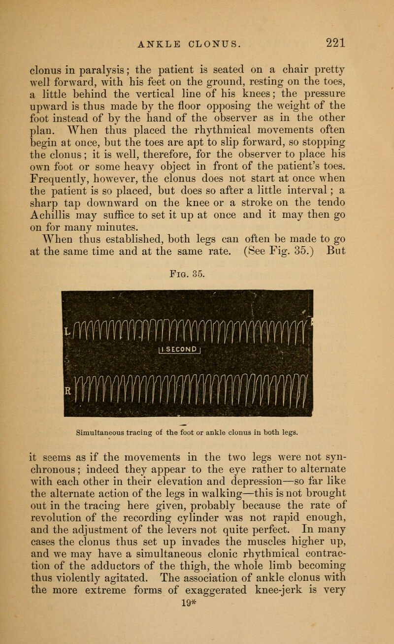 clonus in paralysis; the patient is seated on a chair pretty well forward, with his feet on the ground, resting on the toes, a little behind the vertical line of his knees; the ^^ressure upward is thus made by the floor opposing the weight of the foot instead of by the hand of the observer as in the other plan. When thus placed the rhythmical movements often begin at once, but the toes are apt to slip forward, so stopping the clonus; it is well, therefore, for the observer to place his own foot or some heavy object in front of the patient's toes. Frequently, however, the clonus does not start at once when the patient is so placed, but does so after a little interval; a sharp tap downward on the knee or a stroke on the tendo A chillis may suffice to set it up at once and it may then go on for many minutes. When thus established, both legs can often be made to go at the same time and at the same rate. (See Fig. 35.) But Fig. 35. Simultaneous tracing of the foot or ankle clonus in both legs. it seems as if the movements in the two legs were not syn- chronous ; indeed they appear to the eye rather to alternate with each other in their elevation and depression—so far like the alternate action of the legs in walking—this is not brought out in the tracing here given, probably because the rate of revolution of the recording cylinder was not rapid enough, and the adjustment of the levers not quite perfect. In many cases the clonus thus set up invades the muscles higher up, and we may have a simultaneous clonic rhythmical contrac- tion of the adductors of the thigh, the whole limb becoming thus violently agitated. The association of ankle clonus with the more extreme forms of exaggerated knee-jerk is very 19*