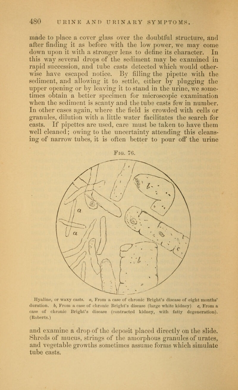 made to place a cover glass over the doubtful structure, and after finding it as before with the low power, we may come down upon it with a stronger lens to define its character. In this way several drops of the sediment may be examined in rapid succession, and tube casts detected which would other- wise have escaped notice. By filling the pij^ette with the sediment, and allowing it to settle, either by plugging the upper opening or by leaving it to stand in the urine, we some- times obtain a better specimen for microscopic examination when the sediment is scanty and the tube casts few in number. In other cases again, where the field is crowded with cells or granules, dilution with a little water facilitates the search for casts. If pipettes are used, care must be taken to have them well cleaned; owing to the uncertainty attending this cleans- ing of narrow tubes, it is often better to pour off the urine Fig. 76. Hyaline, or waxy casts, a, From a case of chronic Bright's disease of eight months' duration, b, From a case of chronic Bright's disease (large white kidney) c, From a case of chronic Bright's disease (contracted kidney, with fattj^ degeneration). (Roberts.) and examine a drop of the deposit placed directly on the slide. Shreds of mucus, strings of the amorphous granules of urates, and vegetable growths sometimes assume forms which simulate tube casts.