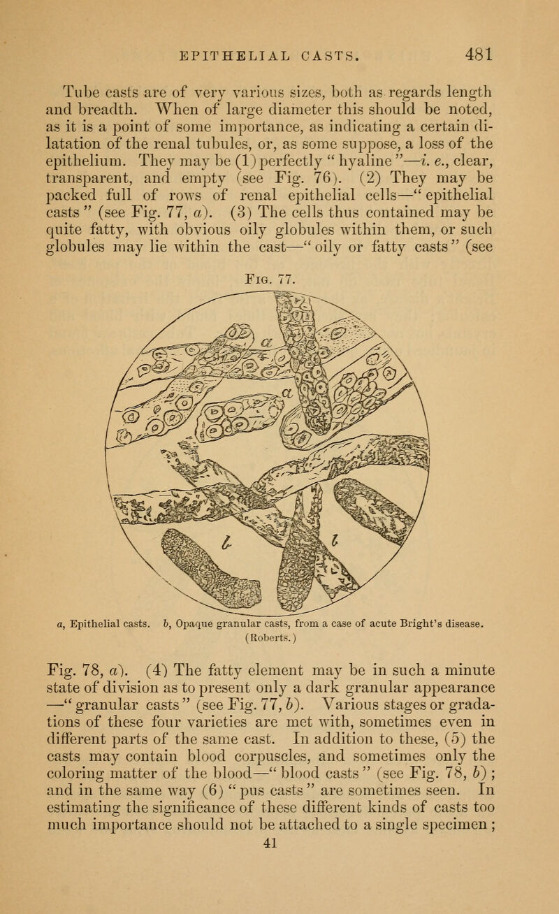 Tube casts are of very various sizes, both as regards length and breadth. When of large diameter this should be noted, as it is a poiut of some importance, as indicating a certain di- latation of the renal tubules, or, as some suppose, a loss of the epithelium. They may be (1) perfectly  hyaline —i. e., clear, transparent, and empty (see Fig. 76). (2) They may be packed full of rows of renal epithelial cells— epithelial casts  (see Fig. 77, a). (3) The cells thus contained may be quite fatty, with obvious oily globules within them, or such globules may lie within the cast—oily or fatty casts (see Fig. 77. a, Epithelial casts, b, Opaque granular casts, from a case of acute Bright's disease. (Roberts. J Fig. 78, a). (4t) The fatty element may be in such a minute state of division as to present only a dark granular appearance — granular casts  (see Fig. 77,6). Various stages or grada- tions of these four varieties are met with, sometimes even in different parts of the same cast. In addition to these, (5) the casts may contain blood corpuscles, and sometimes only the coloring matter of the blood— blood casts  (see Fig. 78, 6) ; and in the same way (6)  pus casts  are sometimes seen. In estimating the significance of these different kinds of casts too much importance should not be attached to a single specimen ; 41