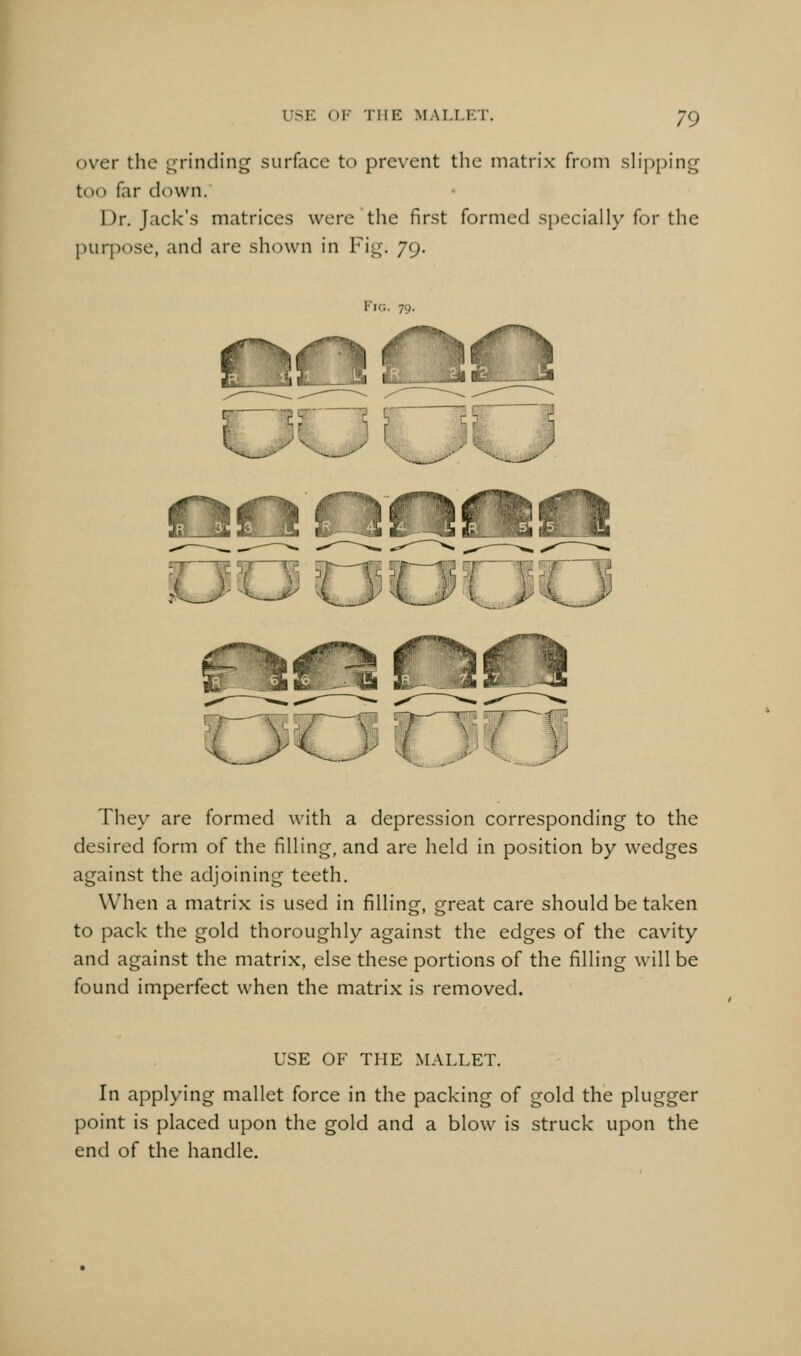 over the grinding surface to prevent the matrix from slipi)ing too far down. Dr. Jack's matrices were the first formed specially for the purpose, and are shown in Fig. 79. Fig. 79. They are formed with a depression corresponding to the desired form of the filling, and are held in position by wedges against the adjoining teeth. When a matrix is used in filling, great care should be taken to pack the gold thoroughly against the edges of the cavity and against the matrix, else these portions of the filling will be found imperfect when the matrix is removed. USE OF THE MALLET. In applying mallet force in the packing of gold the plugger point is placed upon the gold and a blow is struck upon the end of the handle.