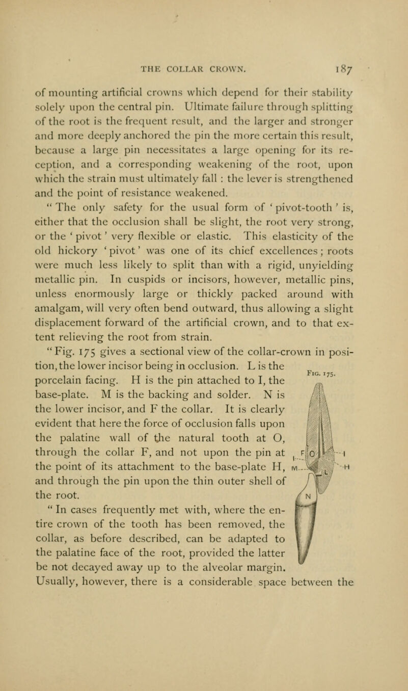 of mounting artificial crowns which depend for their stabihty solely upon the central pin. Ultimate failure throu<^h splitting of the root is the frequent result, and the larger and stronger and more deeply anchored the pin the more certain this result, because a large pin necessitates a large opening for its re- ception, and a corresponding weakening of the root, upon which the strain must ultimately fall : the lever is strengthened and the point of resistance weakened.  The only safety for the usual form of ' pivot-tooth ' is, either that the occlusion shall be slight, the root very strong, or the ' pi\'ot ' very flexible or elastic. This elasticity of the old hickory * pivot' was one of its chief excellences ; roots were much less likely to split than with a rigid, unyielding metallic pin. In cuspids or incisors, however, metallic pins, unless enormously large or thickly packed around with amalgam, will very often bend outward, thus allowing a slight displacement forward of the artificial crown, and to that ex- tent relieving the root from strain. Fig. 175 gives a sectional view of the collar-crown in posi- tion, the lower incisor being in occlusion. L is the . . . . Fig. 175. porcelain facing. H is the pin attached to I, the base-plate. M is the backing and solder. N is the lower incisor, and F the collar. It is clearly evident that here the force of occlusion falls upon the palatine wall of Ijie natural tooth at O, through the collar F, and not upon the pin at the point of its attachment to the base-plate H, and through the pin upon the thin outer shell of the root.  In cases frequently met with, where the en- tire crown of the tooth has been removed, the collar, as before described, can be adapted to the palatine face of the root, provided the latter be not decayed away up to the alveolar margin. Usually, however, there is a considerable space between the