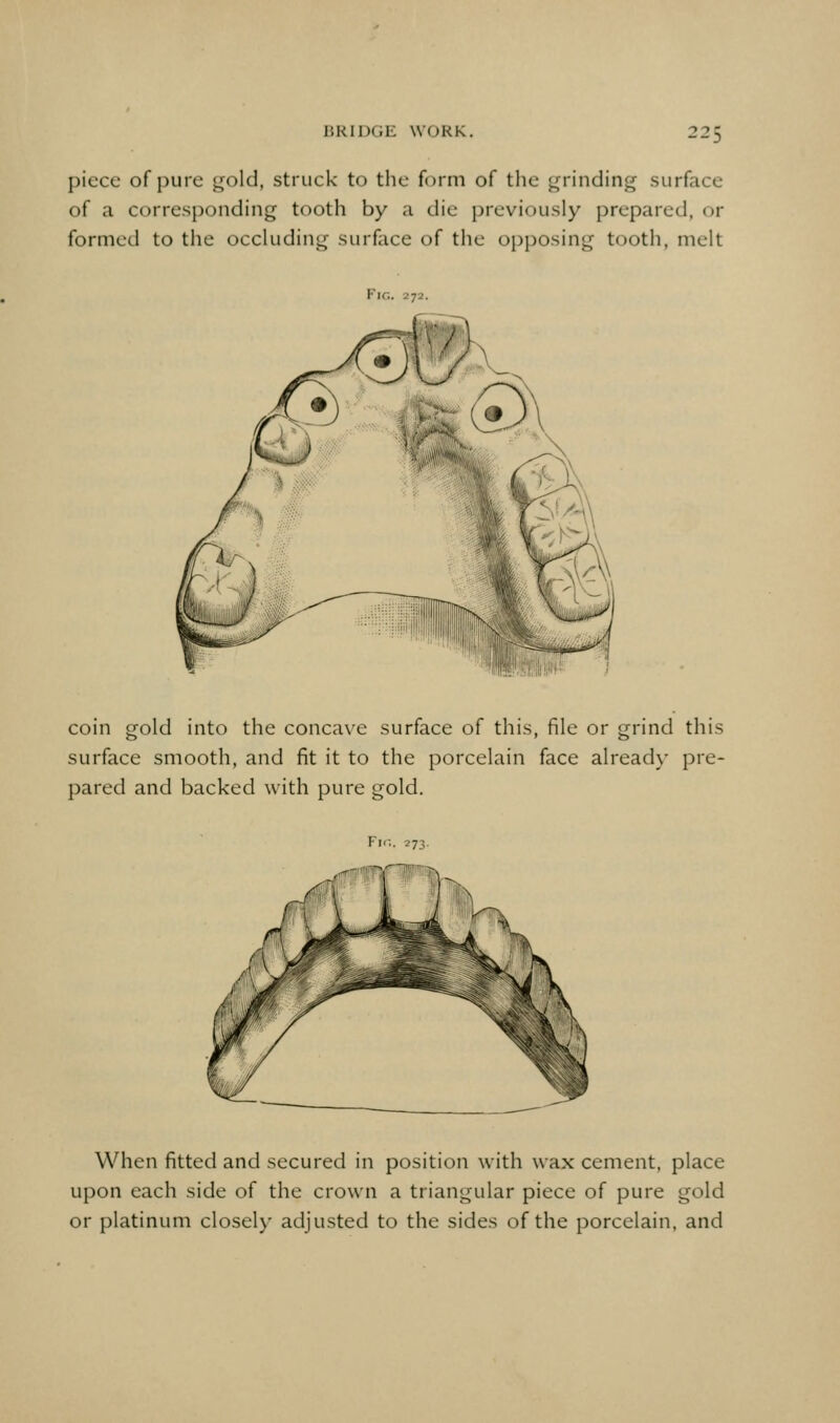 piece of pure gold, struck to the form of the grinding surface of a corresponding tooth by a die previously prepared, or formed to the occluding surface of the opposing tooth, melt Fig. 272. coin gold into the concave surface of this, file or grind this surface smooth, and fit it to the porcelain face already pre- pared and backed with pure gold. Fi< When fitted and secured in position with wax cement, place upon each side of the crown a triangular piece of pure gold or platinum closely adjusted to the sides of the porcelain, and