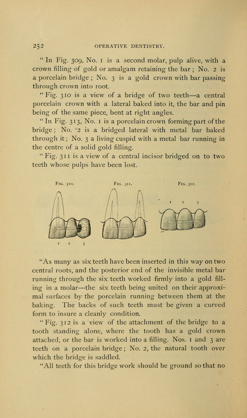  In Fig. 309, No. I is a second molar, pulp alive, with a crown filling of gold or amalgam retaining the bar ; No. 2 is a porcelain bridge ; No. 3 is a gold crown with bar passing through crown into root. Fig. 310 is a view of a bridge of two teeth—a central porcelain crown with a lateral baked into it, the bar and pin being of the same piece, bent at right angles.  In Fig. 313, No. I is a porcelain crown forming part of the bridge ; No. '2 is a bridged lateral with metal bar baked through it; No. 3 a living cuspid with a metal bar running in the centre of a solid gold filling.  Fig. 311 is a view of a central incisor bridged on to two teeth whose pulps have been lost. Fig. 310. Fig. 311. Fig. 312. As many as six teeth have been inserted in this way on two central roots, and the posterior end of the invisible metal bar running through the six teeth worked firmly into a gold fill- ing in a molar—the six teeth being united on their approxi- mal surfaces by the porcelain running between them at the baking. The backs of such teeth must be given a curved form to insure a cleanly condition.  Fig. 312 is a view of the attachment of the bridge to a tooth .standing alone, where the tooth has a gold crown attached, or the bar is worked into a filling. Nos. i and 3 are teeth on a porcelain bridge ; No. 2, the natural tooth over which the bridge is saddled. All teeth for this bridge work should be ground so that no