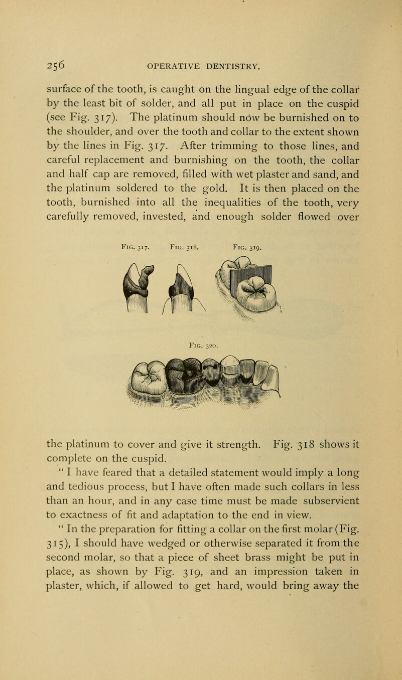 surface of the tooth, is caught on the Hngual edge of the collar by the least bit of solder, and all put in place on the cuspid (see Fig. 317). The platinum should nOw be burnished on to the shoulder, and over the tooth and collar to the extent shown by the lines in Fig. 317. After trimming to those lines, and careful replacement and burnishing on the tooth, the collar and half cap are removed, filled with wet plaster and sand, and the platinum soldered to the gold. It is then placed on the tooth, burnished into all the inequalities of the tooth, very carefully removed, invested, and enough solder flowed over Fig. 317. Fig. 31 Fig. 319. Fig. 320. the platinum to cover and give it strength. Fig. 318 shows it complete on the cuspid.  I have feared that a detailed statement would imply a long and tedious process, but I have often made such collars in less than an hour, and in any case time must be made subservient to exactness of fit and adaptation to the end in view.  In the preparation for fitting a collar on the first molar (Fig. 315), I should have wedged or otherwise separated it from the second molar, so that a piece of sheet brass might be put in place, as shown by Fig. 319, and an impression taken in plaster, which, if allowed to get hard, would bring away the