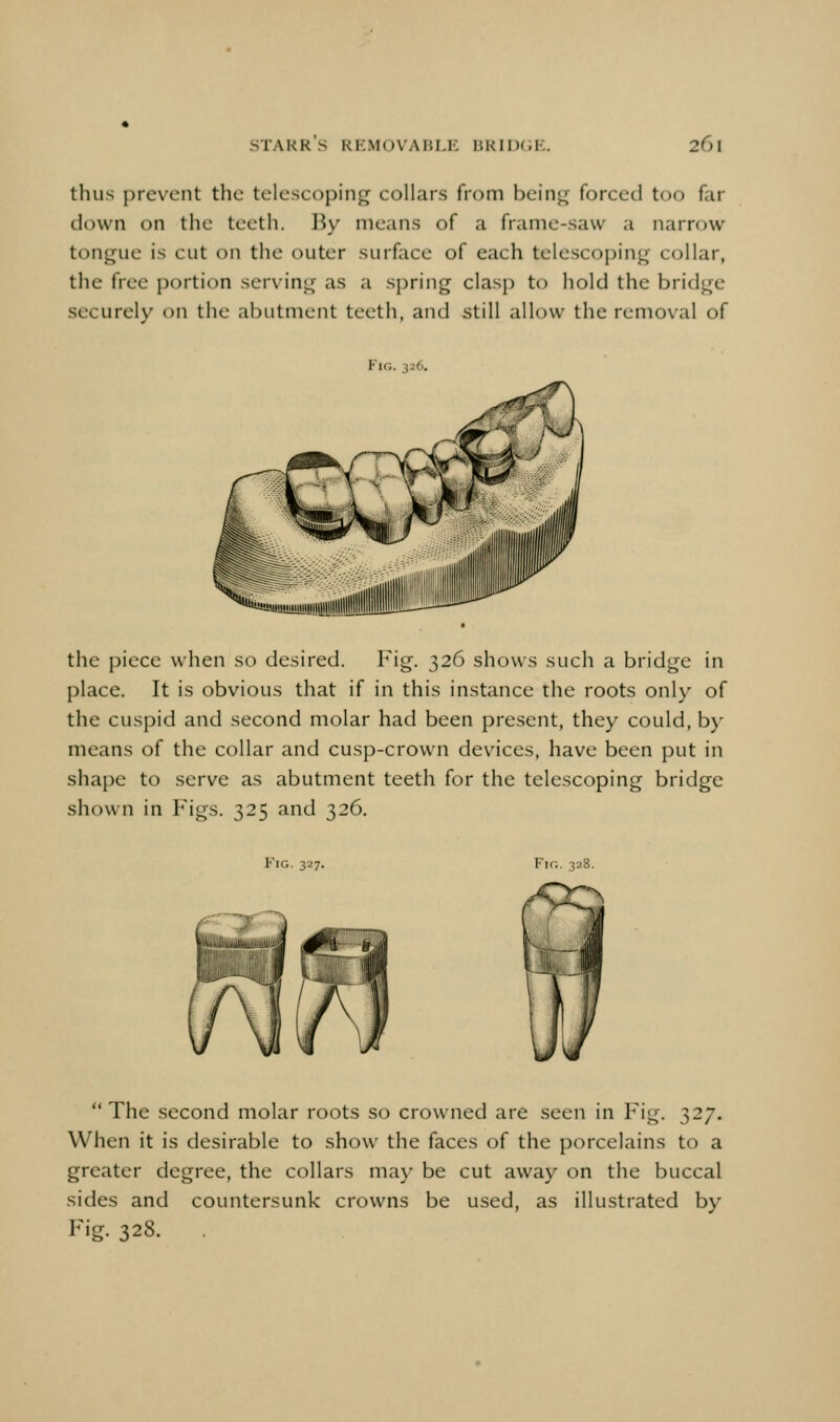 thus prevent the telescoping collars from bein<^ forced too far down on the teeth. By means of a frame-saw a narrow tongue is cut on the outer surface of each telescoping collar, the free portion serving as a spring clasp to hold the bridge securely on the abutment teeth, and still allow the removal of Fig. 326. the piece when so desired. T'ig. 326 shows such a bridge in place. It is obvious that if in this instance rhe roots only of the cuspid and second molar had been present, they could, by means of the collar and cusp-crown devices, have been put in shape to serve as abutment teeth for the telescoping bridge shown in Figs. 325 and 326. Fig. 327. Fk;. 32 The second molar roots so crowned are seen in Fig. 327. When it is desirable to show the faces of the porcelains to a greater degree, the collars maj' be cut away on the buccal sides and countersunk crowns be used, as illustrated by Fig. 328.