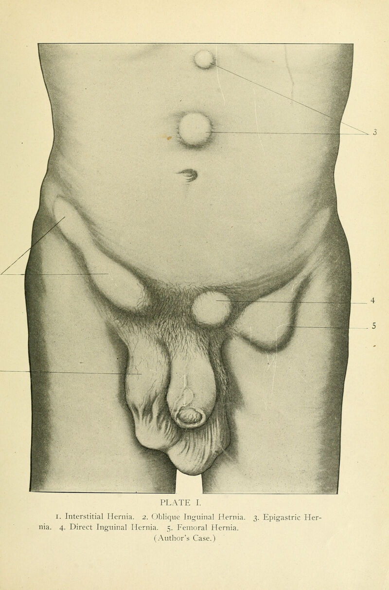 I. Interstitial Hernia. 2. Oblique Inguinal Hernia. 3. Epigastric Eler- nia. 4. Direct Inguinal Hernia. 5. Femoral Hernia. (Author's Case.)