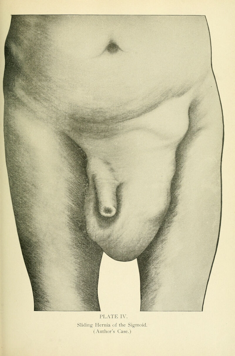 Sliding Hernia of the Sigmoid. (Author's Case.)