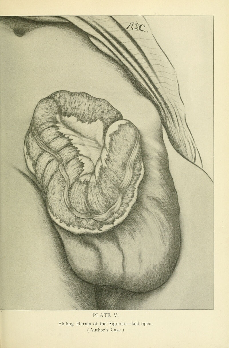 Sliding Hernia of the Sigmoid—laid open. (z-\nthor's Case.)