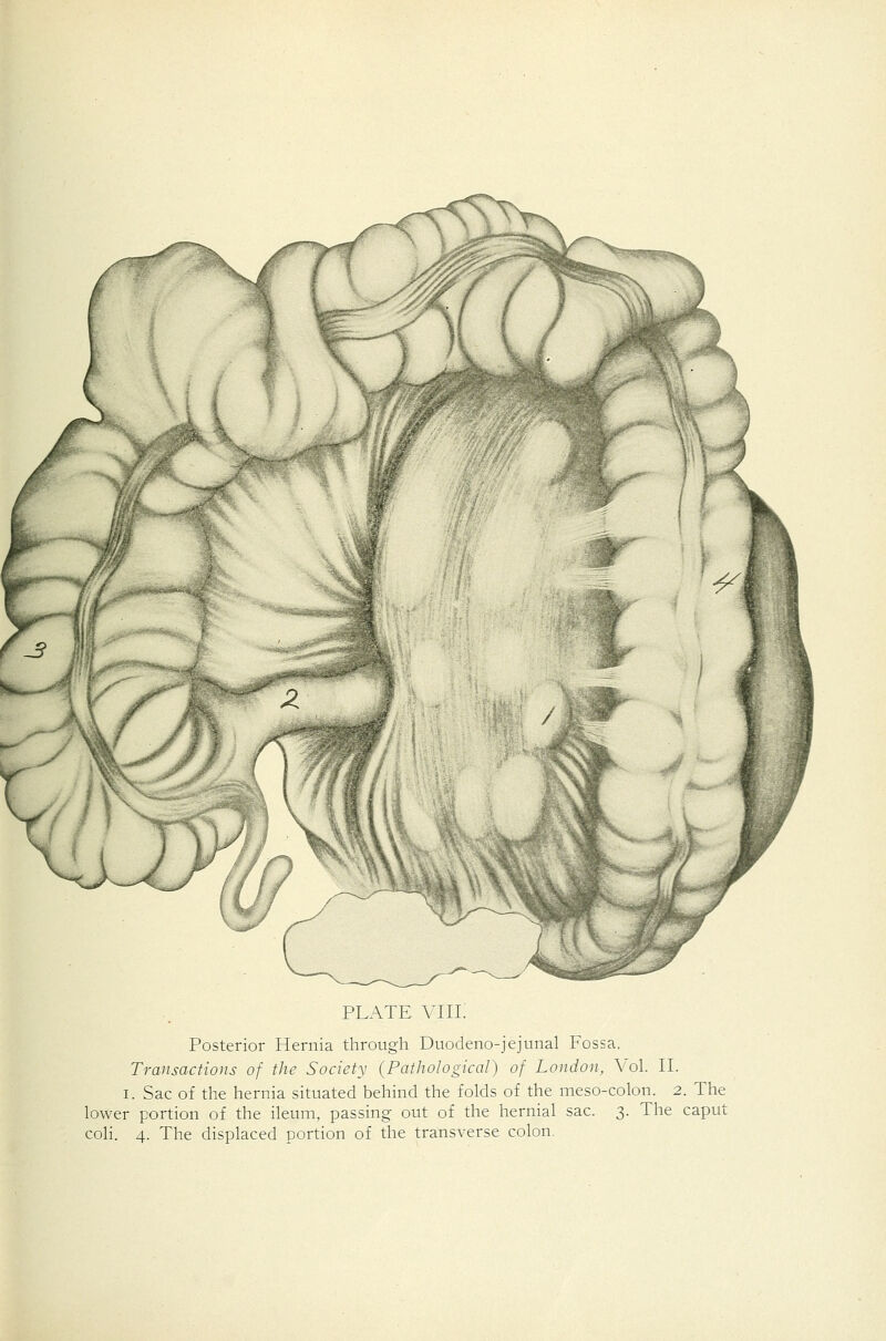 PLATE Mil. Posterior Hernia through Duodeno-jejunal Fossa. Transactions of the Society (Pathological) of London, \'ol. II. I. Sac of the hernia situated behind the folds of the meso-colon. 2. The lower portion of the ileum, passing out of the hernial sac. 3. The caput