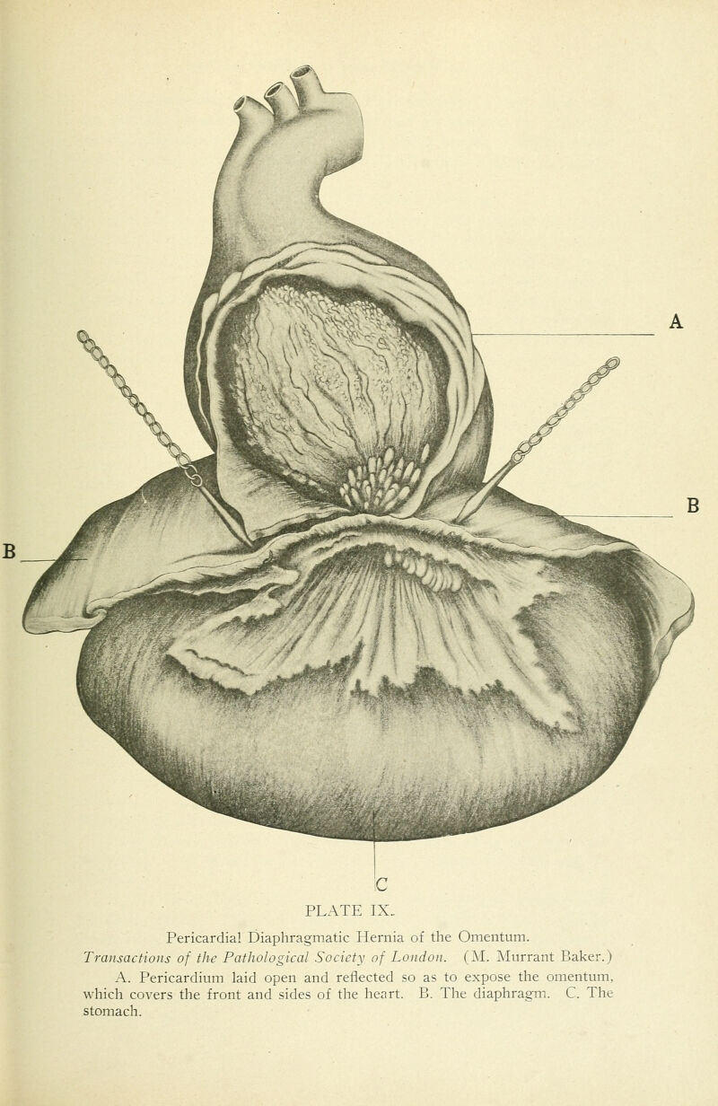 Pericardial Diaphragmatic Hernia of the Omentum. Transactions of the Pathological Society of London. (M. Miirrant Baker.) A. Pericardium laid open and reflected so as to expose the omentum, which covers the front and sides of the heart. B. The diaphragmi. C. The stomach.
