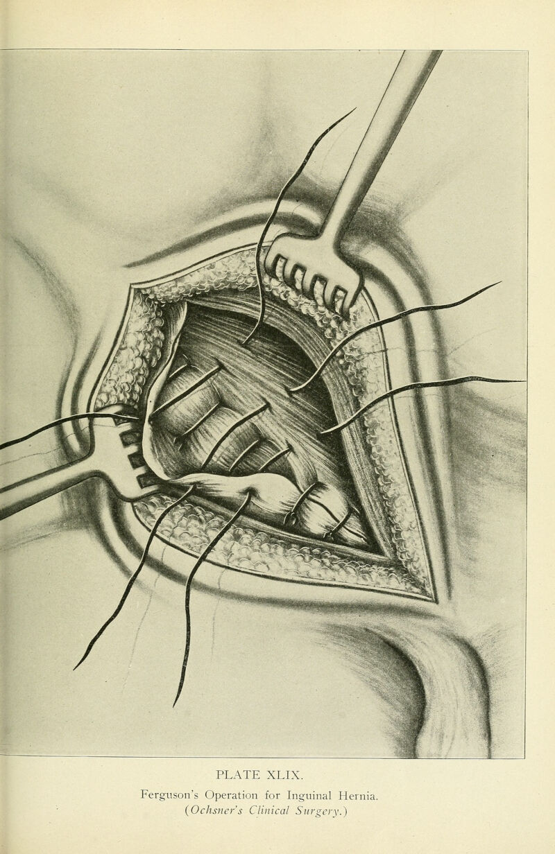 Ferguson's Operation for Inguinal Hernia. (Ochsner's Clinical Suro-ery.)