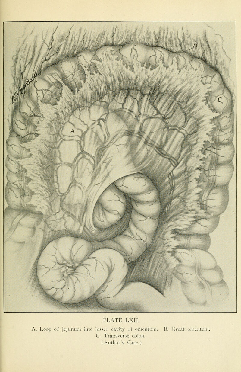 A. Loop of jejunum into lesser cavity of omentum. B. Great omentum. C. Transverse colon. (Author's Case.)