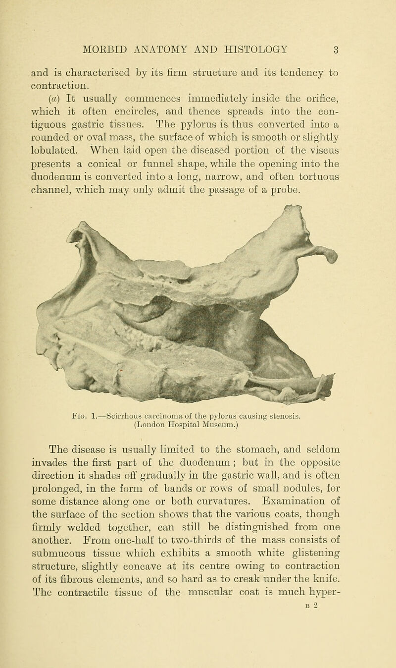 and is characterised by its firm structure and its tendency to contraction. (a) It usually commences immediately inside the orifice, which it often encircles, and thence spreads into the con- tiguous gastric tissues. The pylorus is thus converted into a rounded or oval mass, the surface of which is smooth or slightly lobulated. When laid open the diseased portion of the viscus presents a conical or funnel shape, while the opening into the duodenum is converted into a long, narrow, and often tortuous channel, which may only admit the passage of a probe. Fig. 1.—Scirrhous carcinoma of the pylorus causing stenosis. (London Hospital Museum.) The disease is usually limited to the stomach, and seldom invades the first part of the duodenum; but in the opposite direction it shades off gradually in the gastric wall, and is often prolonged, in the form of bands or rows of small nodules, for some distance along one or both curvatures. Examination of the surface of the section shows that the various coats, though firmly welded together, can still be distinguished from one another. From one-half to two-thirds of the mass consists of submucous tissue which exhibits a smooth white glistening structure, slightly concave at its centre owing to contraction of its fibrous elements, and so hard as to creak under the knife. The contractile tissue of the muscular coat is much hyper- 13 2