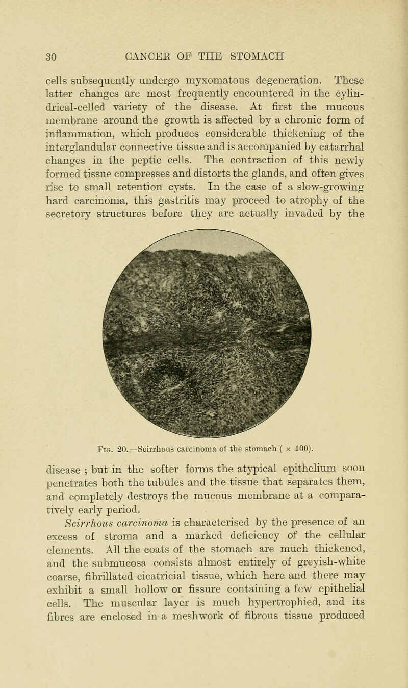 cells subsequently undergo myxomatous degeneration. These latter changes are most frequently encountered in the cylin- drical-celled variety of the disease. At first the mucous membrane around the growth is affected by a chronic form of inflammation, which produces considerable thickening of the interglandular connective tissue and is accompanied by catarrhal changes in the peptic cells. The contraction of this newly formed tissue compresses and distorts the glands, and often gives rise to small retention cysts. In the case of a slow-growing hard carcinoma, this gastritis may proceed to atrophy of the secretory structures before they are actually invaded by the Fig. 20.—Scirrhous carcinoma of the stomach ( x 100). disease ; but in the softer forms the atypical epithelium soon penetrates both the tubules and the tissue that separates them, and completely destroys the mucous membrane at a compara- tively early period. Scirrhous carcinoma is characterised by the presence of an excess of stroma and a marked deficiency of the cellular elements. All the coats of the stomach are much thickened, and the submucosa consists almost entirely of greyish-white coarse, fibrillated cicatricial tissue, which here and there may exhibit a small hollow or fissure containing a few epithelial cells. The muscular layer is much hypertrophied, and its fibres are enclosed in a meshwork of fibrous tissue produced