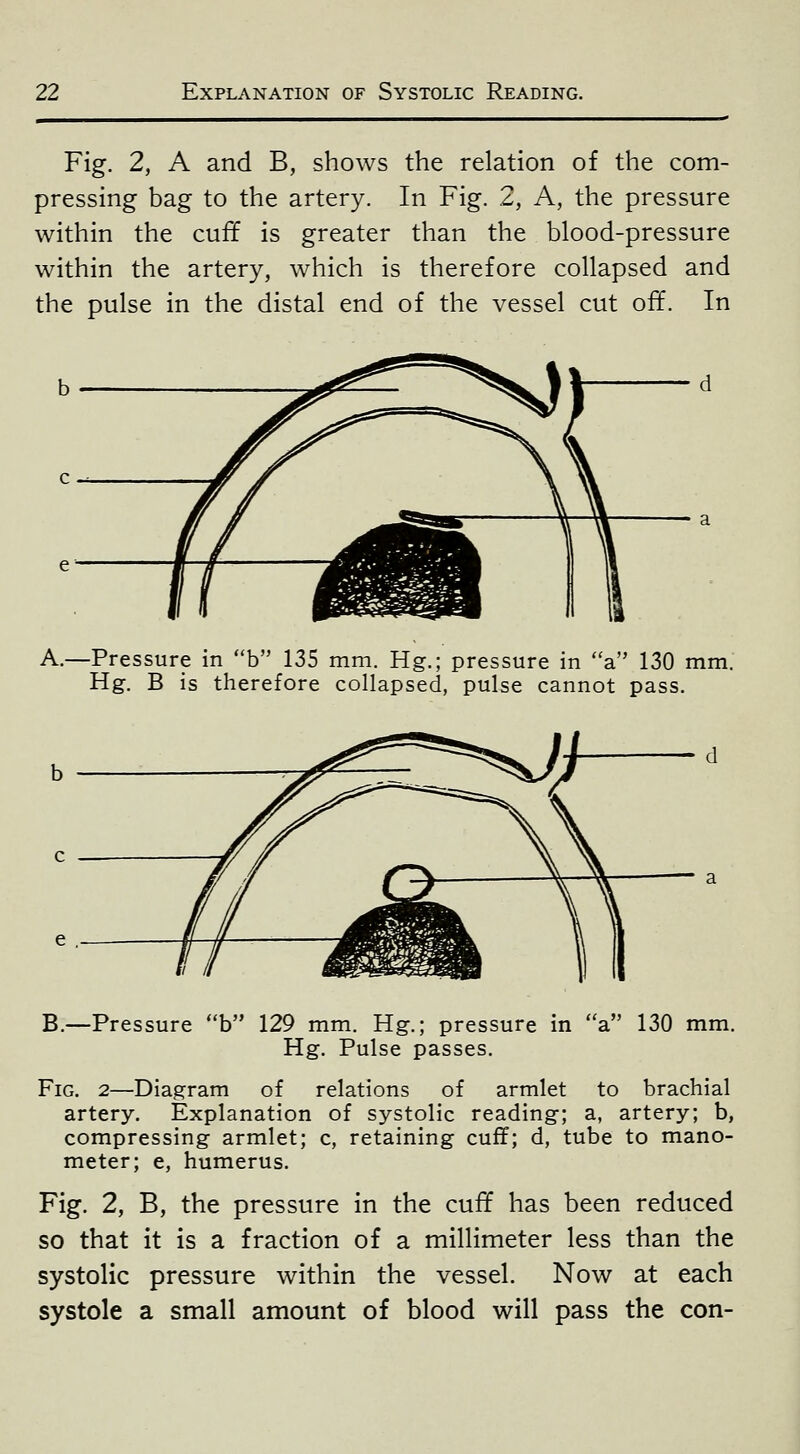 Fig. 2, A and B, shows the relation of the com- pressing bag to the artery. In Fig. 2, A, the pressure within the cuff is greater than the blood-pressure within the artery, which is therefore collapsed and the pulse in the distal end of the vessel cut off. In -Pressure in b 135 mm. Hg.; pressure in a 130 mm. Hg. B is therefore collapsed, pulse cannot pass. B.—Pressure b 129 mm. Hg.; pressure in a 130 mm. Hg. Pulse passes. Fig. 2—Diagram of relations of armlet to brachial artery. Explanation of systolic reading; a, artery; b, compressing armlet; c, retaining cuff; d, tube to mano- meter; e, humerus. Fig. 2, B, the pressure in the cuff has been reduced so that it is a fraction of a millimeter less than the systolic pressure within the vessel. Now at each systole a small amount of blood will pass the con-