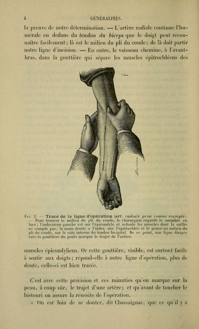 la preuve de notre détermination* — L'artère radiale continue l'hu- mérale en dedans du tendon du biceps que le doigt peut recon- naître facilement ; là est le milieu du pli du coude ; de là doit partir notre ligne d'incision. — En outre, le vaisseau chemine, à l'avant- bras, dans la gouttière qui sépare les muscles épitrochléens des Fit. 2. — Tracé de la ligne d'opération {art. radiale prise comme exemple). — Pour trouver le milieu du pli du coude, le chirurgien regarde le membre en lace; l'indicateur gauche est sur l'épicondyle et refoule les muscles dont la saillie ne compte pas; la main droite a l'index sur l'épitrochlée et le pouce au milieu du pli du coude, sur le côte interne du tendon bicipital. De ce point, une ligue dirigée vers la gouttière du pouls marque le trajet de l'artère. muscles épicondyliens. Or celte gouttière, visible, est surtout facile à sentir aux doigts; répond-elle à notre ligne d'opération, plus de doute, celle-ci est bien tracée. C'est avec cette précision et ces minuties qu'on marque sur la peau, à coup sur, le trajet d'une artère; et qu'avant de toucher le bistouri on assure la réussite de l'opération. « On est loin de se douter, dil Chassaignae, que ce qu'il vu