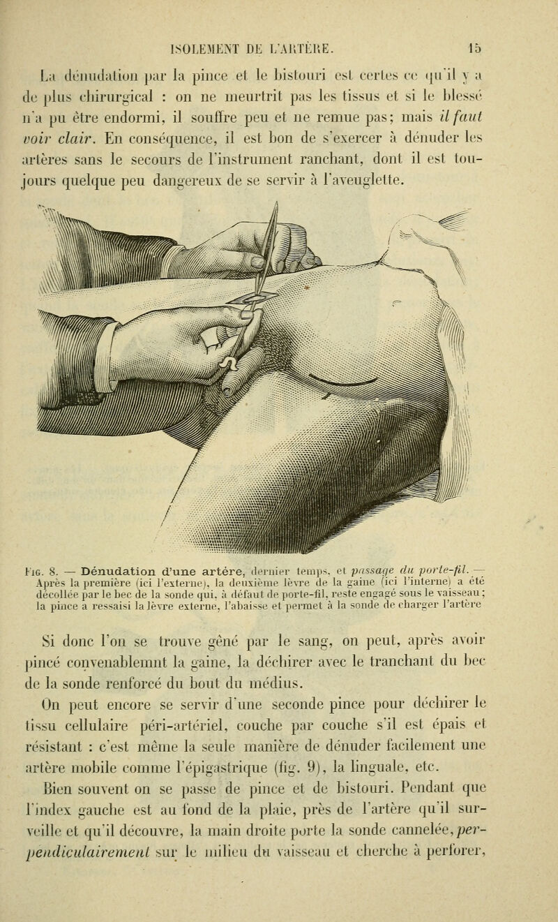 La dénudation par la pince et le bistouri est certes ce qu il y a de plus chirurgical : on ne meurtrit pas les tissus et si le blessé n'a pu être endormi, il souffre peu et ne remue pas; mais il faut voir clair. En conséquence, il est bon de s'exercer à dénuder les artères sans le secours de l'instrument ranchant, dont il est tou- jours quelque peu dangereux de se servir à l'aveuglette. Fig. 8. — Dénudation d'une artère, dernier temps, et passage du porte-fil.— Après la première (ici l'externe), la deuxième lèvre de la gaine (ici l'interne) a été décollée par le bec de la sonde qui. à défaut de porte-fil. reste engagé sous le vaisseau ; la pince a ressaisi la lèvre externe, l'abaisse et pei'met à la sonde de charger l'artère Si donc l'on se trouve gêné par le sang, on peut, après avoir pincé convenablemnt la gaine, la déchirer avec le tranchant du bec de la sonde renforcé du bout du médius. On peut encore se servir d'une seconde pince pour déchirer le tissu cellulaire péri-art ériel, couche par couche s'il est épais et résistant : c'est même la seule manière de dénuder facilement une artère mobile comme l'épigastrique (fig. 9), la linguale, etc. Bien souvent on se passe de pince et de bistouri. Pendant que l'index gauche est au fond de la plaie, près de l'artère qu il sur- veille et qu'il découvre, la main droite porte la sonde cannelée,per- pendiculairement sur le milieu du vaisseau et cherche à perforer,