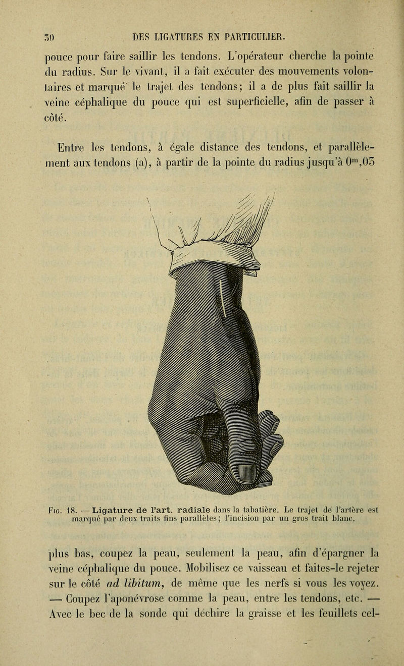 pouce pour faire saillir les tendons. L'opérateur cherche la pointe du radius. Sur le vivant, il a fait exécuter des mouvements volon- taires et marqué le trajet des tendons; il a de plus fait saillir la veine céphalique du pouce qui est superficielle, afin de passer à côté. Entre les tendons, à égale distance des tendons, et parallèle- ment aux tendons (a), à partir de la pointe du radius jusqu'à 0m,05 Fie. 18. — Ligature de l'art, radiale dans la tabatière. Le trajet de l'artère est marqué par deux traits fins parallèles ; l'incision par un gros tirait blanc. plus bas, coupez la peau, seulement la peau, afin d'épargner la veine céphalique du pouce. Mobilisez ce vaisseau et faites-le rejeter sur le côté ad libitum, de même que les nerfs si vous les voyez. — Coupez l'aponévrose comme la peau, entre les tendons, etc. — Avec le bec de la sonde qui déchire la graisse et les feuillets cel-