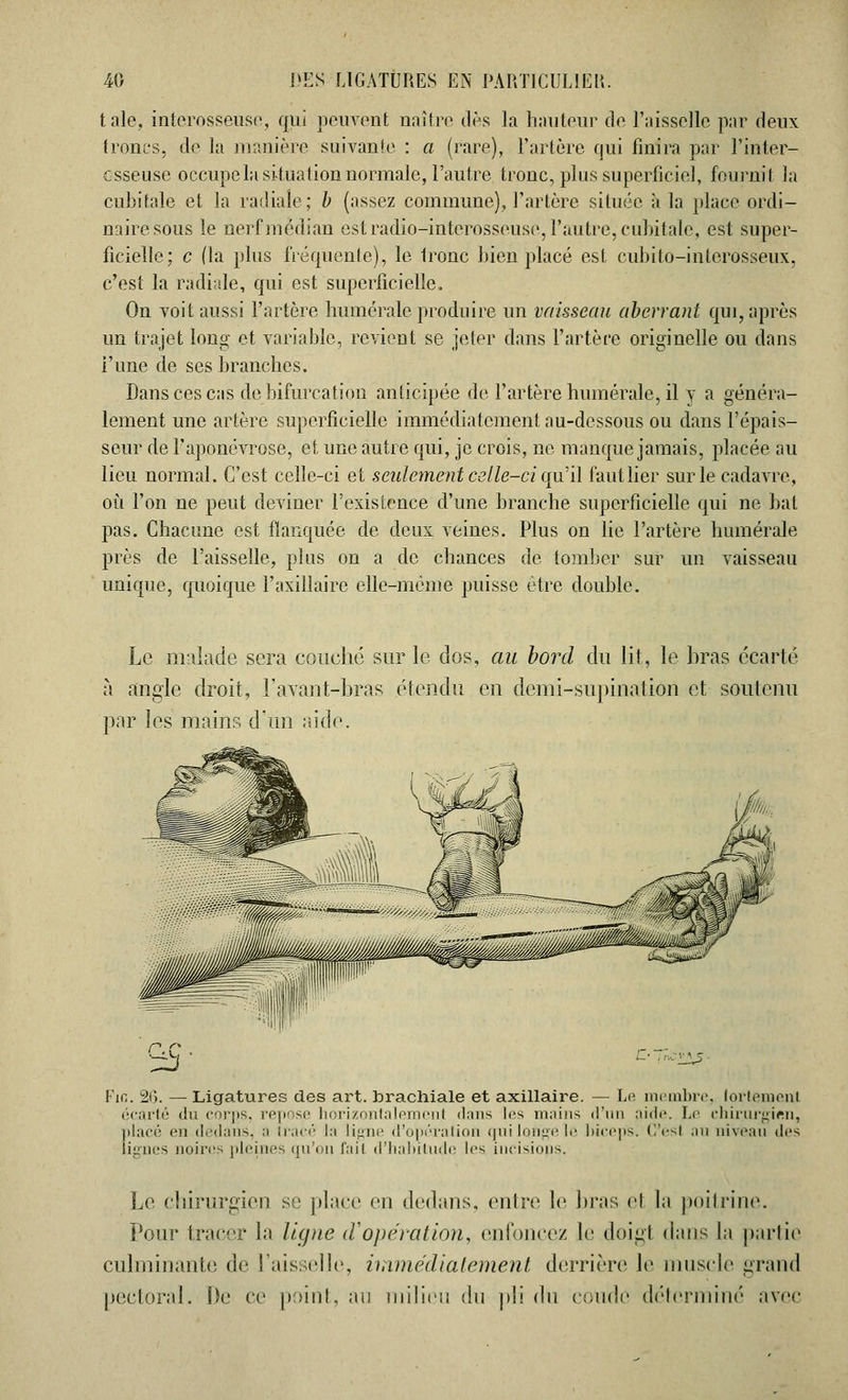 taie, interosseuse, qui peuvent naître dès la hauteur de l'aisselle par deux troncs, de la manière suivante : a (rare), l'artère qui finira par l'inter- csseuse occupe la situation normale, l'autre tronc, plus superficiel, fournil la cubitale et la radiale; b (assez commune), l'artère située à la place ordi- naire sous le nerf médian est radio-interosseuse, l'autre, cubitale, est super- ficielle; c (la plus fréquente), le tronc bien placé est cubito-interosseux, c'est la radiale, qui est superficielle. On voit aussi l'artère numérale produire un vaisseau aberrant qui, après un trajet long et variable, revient se jeter dans l'artère originelle ou dans l'une de ses branches. Dans ces cas de bifurcation anticipée de l'artère numérale, il y a généra- lement une artère superficielle immédiatement au-dessous ou dans l'épais- seur de l'aponévrose, et une autre qui, je crois, ne manque jamais, placée au lieu normal. C'est celle-ci et seulement celle-ci qu'il faut lier sur le cadavre, où l'on ne peut deviner l'existence d'une branche superficielle qui ne bat pas. Chacune est flanquée, de deux veines. Plus on lie l'artère numérale près de l'aisselle, plus on a de chances de tomber sur un vaisseau unique, quoique l'axillaire elle-même puisse être double. Le malade sera couché sur le dos, au bord du lit, le bras écarté à angle droit, l'avant-bras étendu en demi-supination et soutenu par les main?, cran aide. Fia. 26. — Ligatures des art. brachiale et axillaire. — Le membre, fortement écarté du corps, repose horizontalement dans les mains d'un pide. Le chirurgien, placé en dedans, ;i tracé la ligne d'opération quilongele biceps. G'esl au niveau des lignes noires pleines qu'on fait d'habitude les incisiops. Le chirurgien se place en dedans, entre le bras et la poitrine. Pour tracer la ligne (Vopération, enfoncez le doigl dans la partie culminante de l'aisselle, immédiatement derrière le muscle grand pectoral. De ce point, au milieu du pli du coude déterminé avec