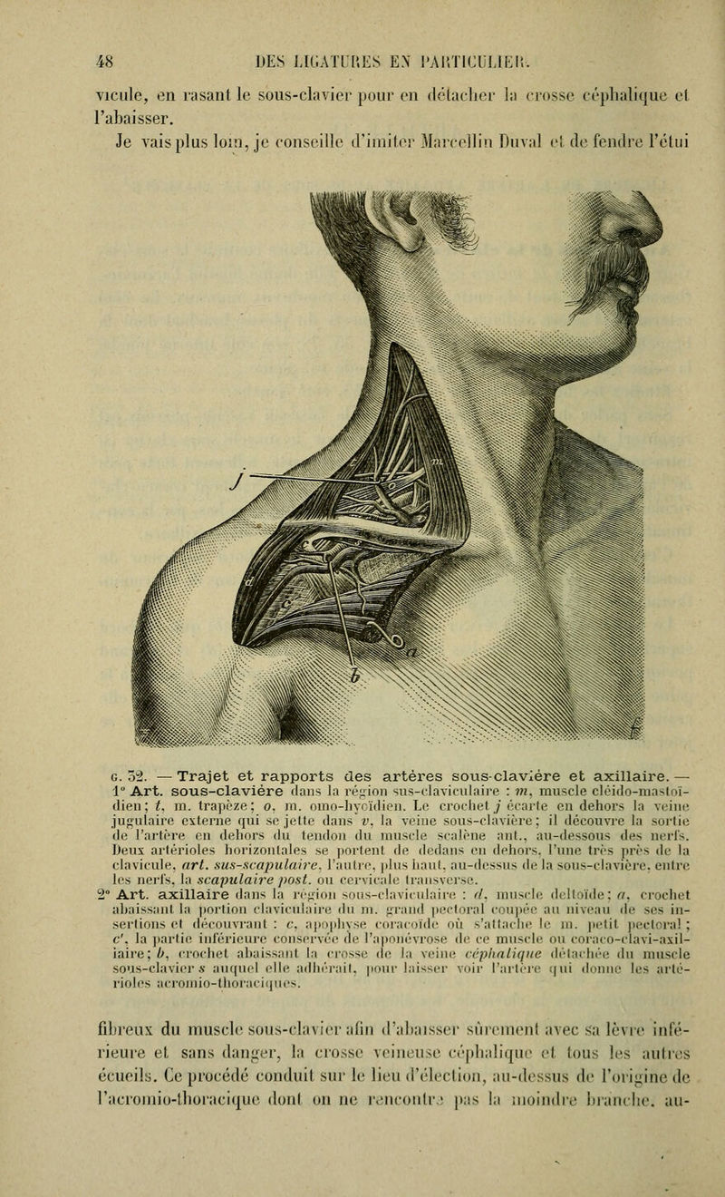 vieille, en rasant le sous-clavier pour en détacher la crosse céphalique et l'abaisser. Je vais plus loin, je conseille d'imiter Marcellin Duval et de fendre l'étui g. oi. — Trajet et rapports des artères sous-claviére et axillaire. — 1° Art. sous-clavière dans la région sus-claviculaire : m, muscle cléido-mastoï- dien; t. m. trapèze; o. m. omo-hycïdien. Le crochet j écarte en dehors la veine jugulaire externe qui se jette dans v. la veine sous-clavière: il découvre ta sortie de l'artère en dehors du tendon du muscle scalène ant., au-dessous des nerfs. Deux artérioles horizontales se portent de dedans en dehors, l'une très près de la clavicule, art. sus-scapulaire. l'autre, plus haut, au-dessus de la sous-clavière, entre les nerfs, la scapulaire post. ou cervicale transverse. 2° Art. axillaire dans la région sous-clavieulaire : d. muscle deltoïde; n. crochet abaissant la portion claviculaire du ni. grand pectoral coupée au niveau de ses in- sertions et découvrant : c, apophyse coracoïde où s'attache le ni. petit pectoral ; c'. la partie inférieure conservée de l'aponévrose de ce muscle ou coraco-clavi-axil- iaire;Z/, crochet abaissant la crosse de la veine céphalique détachée du muscle sous-clavier .s- auquel elle adhérait, pour laisser voir l'artère qui donne les arté- rioles acroroio-thoraciques. fibreux du muscle sous-clavier afin d'abaisser sucement avec sa lèvre infé- rieure et sans danger, la crosse veineuse céphalique H tous les ailles écueils. Ce procédé conduit sur le Heu d'élection, au-dessus «le l'origine de Pacromio-thoracique dont on ne rencontra pas lu moindre branche, au-