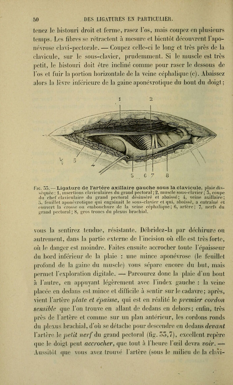 tenez le bistouri droit et ferme, rasez l'os, mais coupez en plusieurs temps. Les fibres se rétractent à mesure et bientôt découvrent l'apo- névrose clavi-pectorale. — Coupez celle-ci le long et très près de la clavicule, sur le sous-clavier, prudemment. Si le muscle est très petit, le bistouri doit être incliné comme pour raser le dessous de l'os et fuir la portion horizontale de la veine cépbalique (c). Abaissez alors la lèvre inférieure de la gaine aponévrotique du bout du doigt ; Fie. >. — Ligature de l'artère axillaire gauche sous la clavicule, plaie dis- séquée : 1, insertions claviculaires du grand pectoral ; 2, muscle sous-clavier; 3, coupe «lu chef claviculaire du grand pectoral désinséré et abaissé; i, veine axillaire; ;;. feuillet aponévrotique qui engainait le sous-clavier et qui, abaissé, a entraîné et (■ouvert la crosse ou embouchure de la veine cépbalique; 6, artère: 7. nerfs du grand pectoral; 8. gros troncs du plexus brachial. vous la sentirez tendue, résistante. Débridez-la par déchirure ou autrement, dans la partie externe de l'incision où elle est très forte, oit le danger est moindre. Faites ensuite accrocher toute l'épaisseur du bord inférieur de la plaie : une mince aponévrose (le feuillet profond de la gaine du muscle) vous sépare encore du but, mais permet l'exploration digitale. — Parcourez donc la plaie d'un bout à l'autre, en appuyant légèrement avec l'index gauche : la veine placée en dedans est mince et difficile à sentir sur le cadavre ; après, vient l'artère plaie et épaisse, qui est en réalité le premier cordon sensible que l'on trouve en allant de dedans en dehors; enfin, très près de l'artère et comme sur un plan antérieur, les cordons ronds du plexus brachial, d'où se détache pour descendre en dedans devant l'artère, le petit nerf du grand pectoral (fig. r>r>,7), excellent repère que le doigt peut accrocher, que tout à l'heure l'œil devra voir. — Aussitôl que vous avez trouvé l'artère (sous le milieu de la clavi-