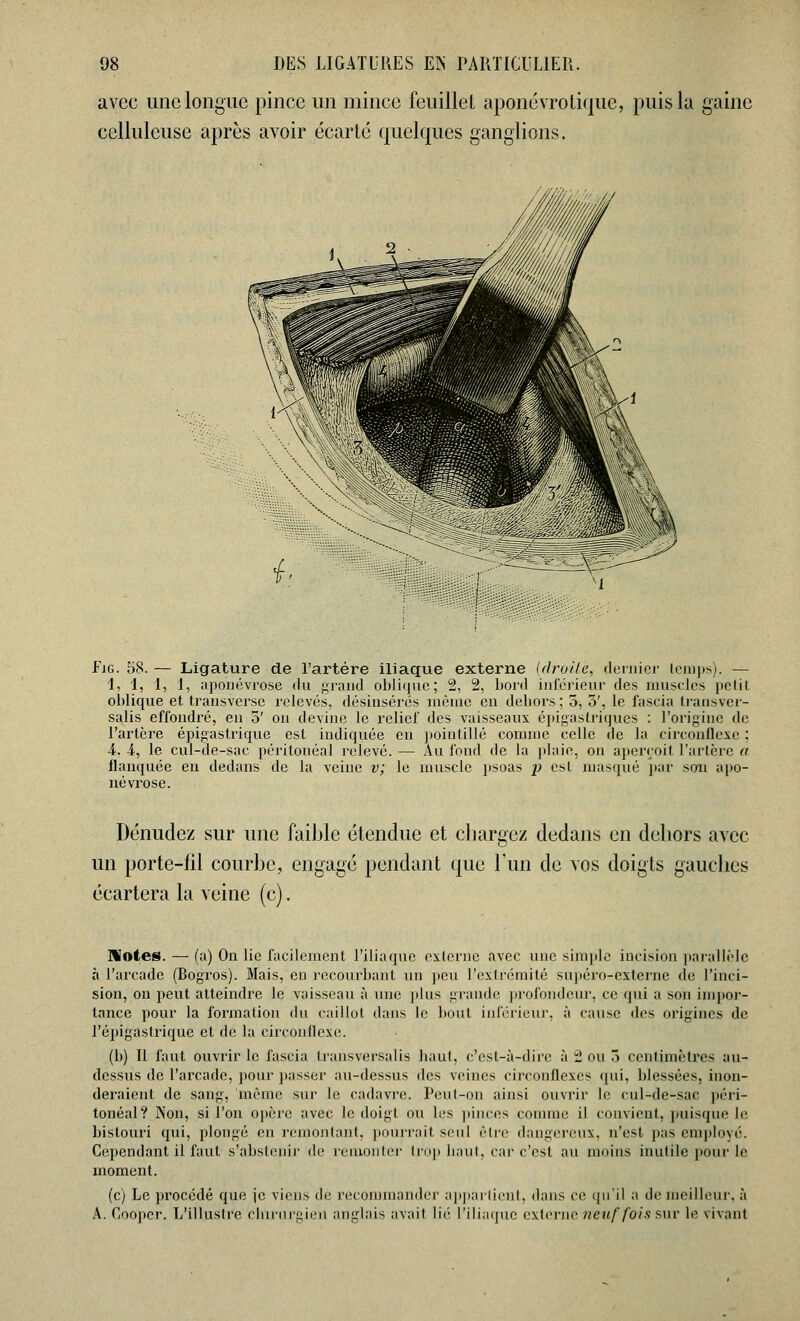 avec une longue pince un mince feuillet aponévrotique, puis la gaine cellulcuse après avoir écarté quelques ganglions. FiG. 58. — Ligature de l'artère iliaque externe (droite, dernier temps). — 1, 1, 1, 1, aponévrose du grand oblique; 2, 2, bord inférieur des muscles petit oblique et transverse relevés, désinsérés môme en dehors ; 5, 5', le fascia transver- salis effondré, en 5' on devine le relief des vaisseaux épigastriques : l'origine de l'artère épigastrique est indiquée en pointillé comme celle de la circonflexe ; •4. 4, le cul-de-sac péritonéal relevé. — Au fond de la plaie, on aperçoit l'artère a flanquée en dedans de la veine v; le muscle psoas p est masqué par son apo- névrose. Dénudez sur une faible étendue et chargez dedans en dehors avec un porte-fil courbe, engagé pendant que l'un de vos doigts gauches écartera la veine (c). Notes. — (a) On lie facilement l'iliaque externe avec une simple incision parallèle à l'arcade (Bogros). Mais, en recourbant un peu l'extrémité supéro-externe de l'inci- sion, on peut atteindre le vaisseau à une plus grande profondeur, ce qui a son impor- tance pour la formation du caillot dans le bout inférieur, à cause des origines de l'épigastrique et de la circonflexe. (h) Il faut ouvrir le fascia transversalis haut, c'est-à-dire à 2 ou 5 centimètres au- dessus de l'arcade, pour passer au-dessus des veines circonflexes qui, blessées, inon- deraient de sang, même sur le cadavre. Peut-on ainsi ouvrir le cul-de-sac péri- tonéal? Non, si l'on opère avec le doigt ou les pinces comme il convient, puisque le bistouri qui, plongé en remontant, pourrait seul être dangereux, n'est pas employé. Cependant il faut s'abstenir de remonter trop haut, car c'est au moins inutile pour le moment. (c) Le procédé que je viens dé recommander appartient, dans ce qu'il a de meilleur, à A. Cooper. L'illustre chirurgien anglais avait lié l'iliaque externe neuf fois sur le vivant