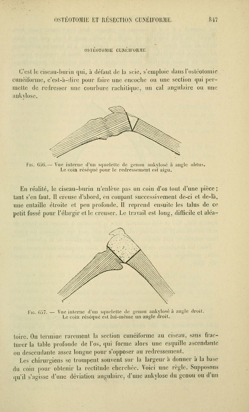 OSTEOTOMIE CUNEIFORME C'est le ciseau-burin qui, à défaut de la scie, s'emploie dans l'ostéotomie cunéiforme, c'est-à-dire pour faire une encoche ou une section qui per- mette de redresser une courbure rachitique, un cal angulaire ou une ankylosé. Fig. 656.— Vue interne d'un squelette de genou ankylosé à angle obtus. Le coin réséqué pour le redressement est aigu. En réalité, le ciseau-burin n'enlève pas un coin d'os tout d'une pièce ; tant s'en faut. Il creuse d'abord, en coupant successivement de-ci et de-là, une entaille étroite et peu profonde. Il reprend ensuite les talus de ce petit fossé pour l'élargir et le creuser. Le travail est long, difficile et aléa- •„,.657. — Vue interne d'un squelette de genou ankylosé à angle droit. Le coin réséqué est lui-même un angle droit. toirc. On termine rarement la section cunéiforme au ciseau, sans frac- turer la table profonde de l'os, qui forme alors une esquille ascendante ou descendante assez longue pour s'opposer au redressement. Les chirurgiens se trompent souvent sur la largeur à donner à la base du coin pour obtenir la rectitude cherchée. Voici une règle. Supposons qu'il s'agisse d'une déviation angulaire, d'une ankylosé du genou ou d'un