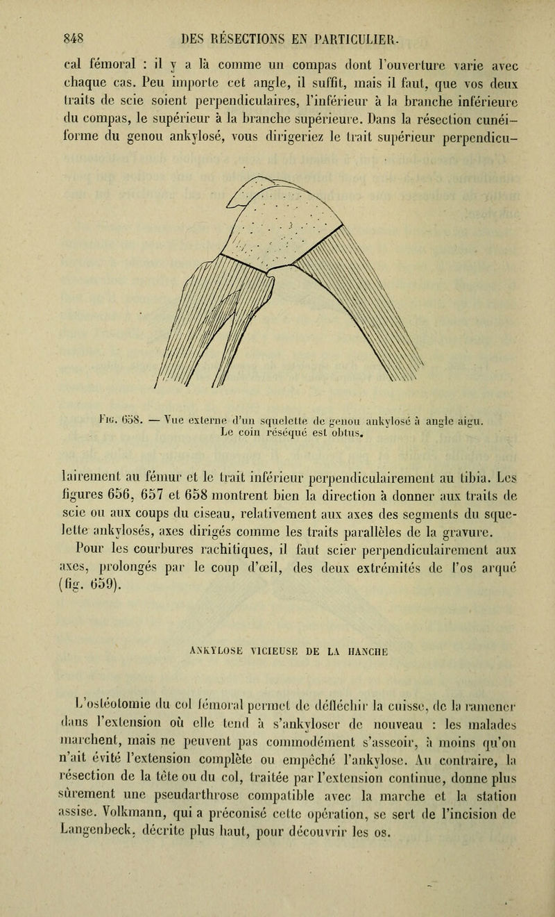 cal fémoral : il y a là comme un compas dont l'ouverture varie avec chaque cas. Peu importe cet angle, il suffit, mais il faut, que vos deux traits de scie soient perpendiculaires, l'inférieur à la branche inférieure du compas, le supérieur à la branche supérieure. Dans la résection cunéi- forme du genou ankylosé, vous dirigeriez le trait supérieur perpcndicu- Jig. <5o8. —Vue externe d'un squelette de genou ankylosé à angle aigu. Le coin réséqué est obtus. laireinent au fémur et le trait inférieur perpendiculairement au tibia. Les ligures 656, 657 et 658 montrent bien la direction à donner aux traits de scie ou aux coups du ciseau, relativement aux axes des segments du sque- lette ankylosés, axes dirigés comme les traits parallèles de la gravure. Pour les courbures rachitiques, il faut scier perpendiculairement aux axes, prolongés par le coup d'œil, des deux extrémités de l'os arqué (fig. 659). ANKÎLOSE VICIEUSE DE LA HANCHE L'ostéotomie du col fémoral permet de défléchir la cuisse, de la ramener dans l'extension où elle tend à s'ankyloscr de nouveau : les malades marchent, mais ne peuvent pas commodément s'asseoir, à moins qu'on n'ait évité l'extension complète ou empêché l'ankylose. Au contraire, la résection de la tète ou du col, traitée par l'extension continue, donne plus sûrement une pseudarthrose compatible avec la marche et la station assise. Volkmann, qui a préconisé cette opération, se sert de l'incision de Langenbeck. décrite plus haut, pour découvrir les os.