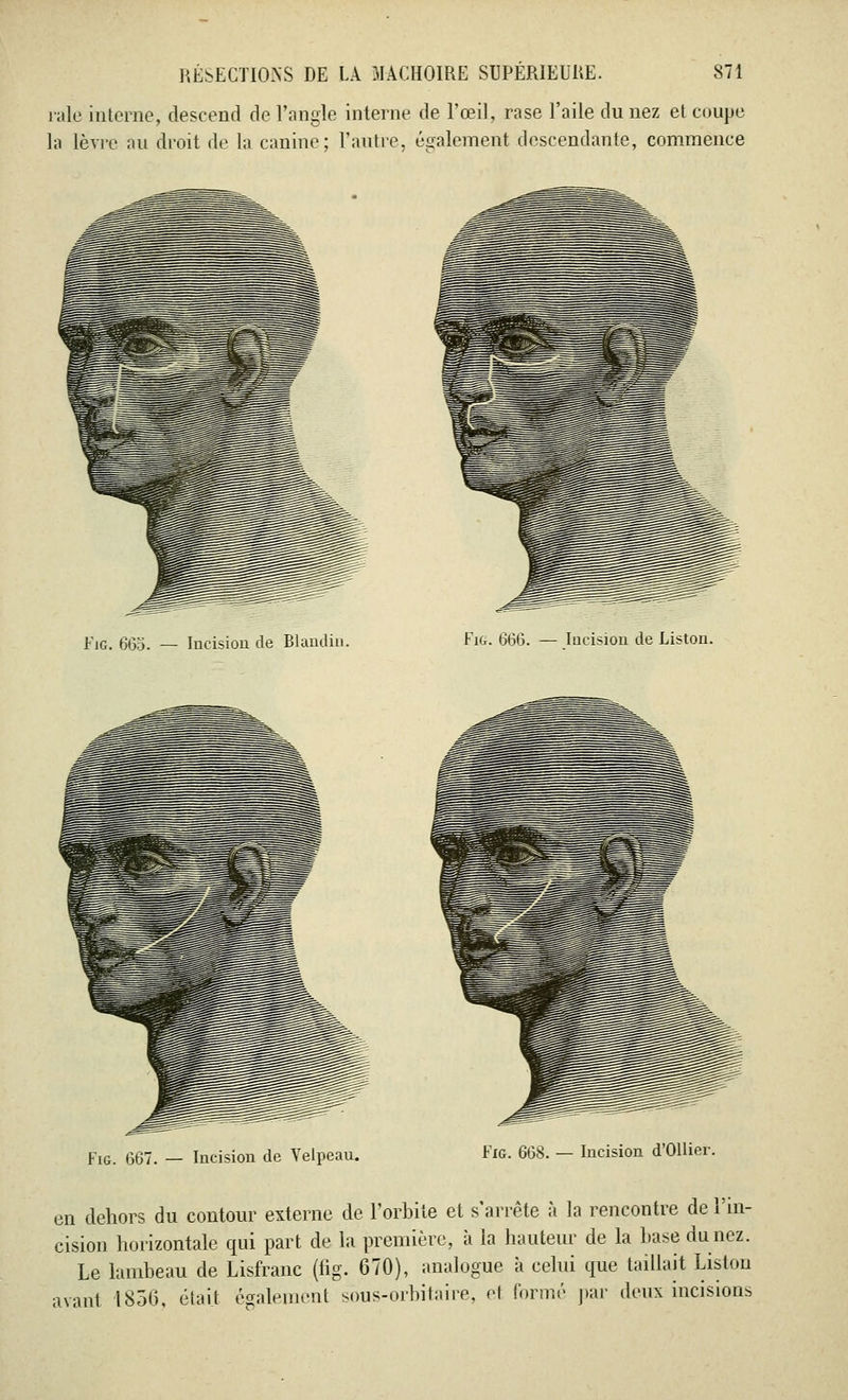 raie interne, descend de l'angle interne de l'œil, rase l'aile du nez et coupe la lèvre au droit de la canine; l'autre, également descendante, commence Fig. 665. — Incision de Blandin. Fit. 666. — Incision de Liston. Fig. 667. — Incision de Velpeau. Fig. 668. — Incision d'Ollier. en dehors du contour externe de l'orbite et s'arrête à la rencontre de l'in- cision horizontale qui part de la première, à la hauteur de la hase dunez. Le lambeau de Lisfranc (fig. 670), analogue à celui que taillait Liston avant 1856, était également sbus-orbitaire, et formé par deux incisions
