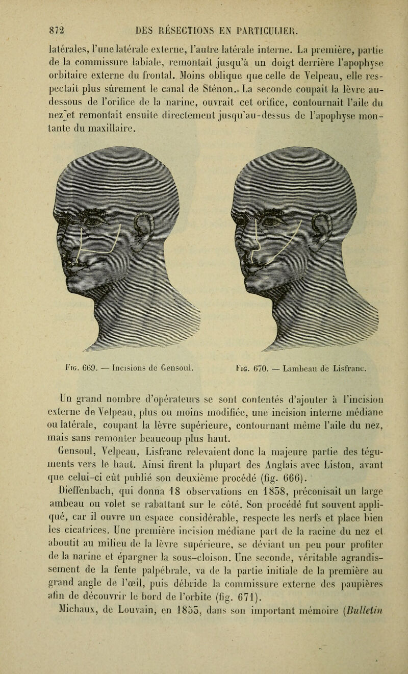 latérales, l'une latérale externe, l'autre latérale interne. La première, partie de la commissure labiale, remontait jusqu'à un doigt derrière l'apophyse orbitaire externe du frontal. Moins oblique que celle de Yelpeau, elle res- pectait plus sûrement le canal de Sténon.. La seconde coupait la lèvre au- dessous de l'orifice de la narine, ouvrait cet orifice, contournait l'aile du nezjst remontait ensuite directement jusqu'au-dessus de l'apophyse mon- tante du maxillaire. Frc. 669. — Incisions do Gensoul. Fig. 670. — Lambeau de Lisfranc. Un grand nombre d'opérateurs se sont contentés d'ajouter à l'incision externe de Yelpeau, plus ou moins modifiée, une incision interne médiane ou latérale, coupant la lèvre supérieure, contournant même l'aile du nez, mais sans remonter beaucoup plus haut. Gensoul, Velpeau, Lisfranc relevaient donc la majeure partie des tégu- ments vers le haut. Ainsi firent la plupart des Anglais avec Liston, avant que celui-ci eût publié son deuxième procédé (fig. 666). Dieffenbach, qui donna 18 observations en 1858, préconisait un large ambeau ou volet se rabattant sur le coté. Son procédé fut souvent appli- qué, car il ouvre un espace considérable, respecte les nerfs et place bien les cicatrices. Une première incision médiane part fie la racine du nez el aboutit au milieu de la lèvre supérieure, se déviant un peu pour profiter de la narine et épargner la sous-cloison. Une seconde, véritable agrandis- sement de la fente palpébrale, va de la partie initiale de la première au grand angle de l'œil, puis débride la commissure externe des paupières afin de découvrir le bord de l'orbite (fig. 671). Michaux, de Louvain, en 1855, dans son important mémoire {Bulletin