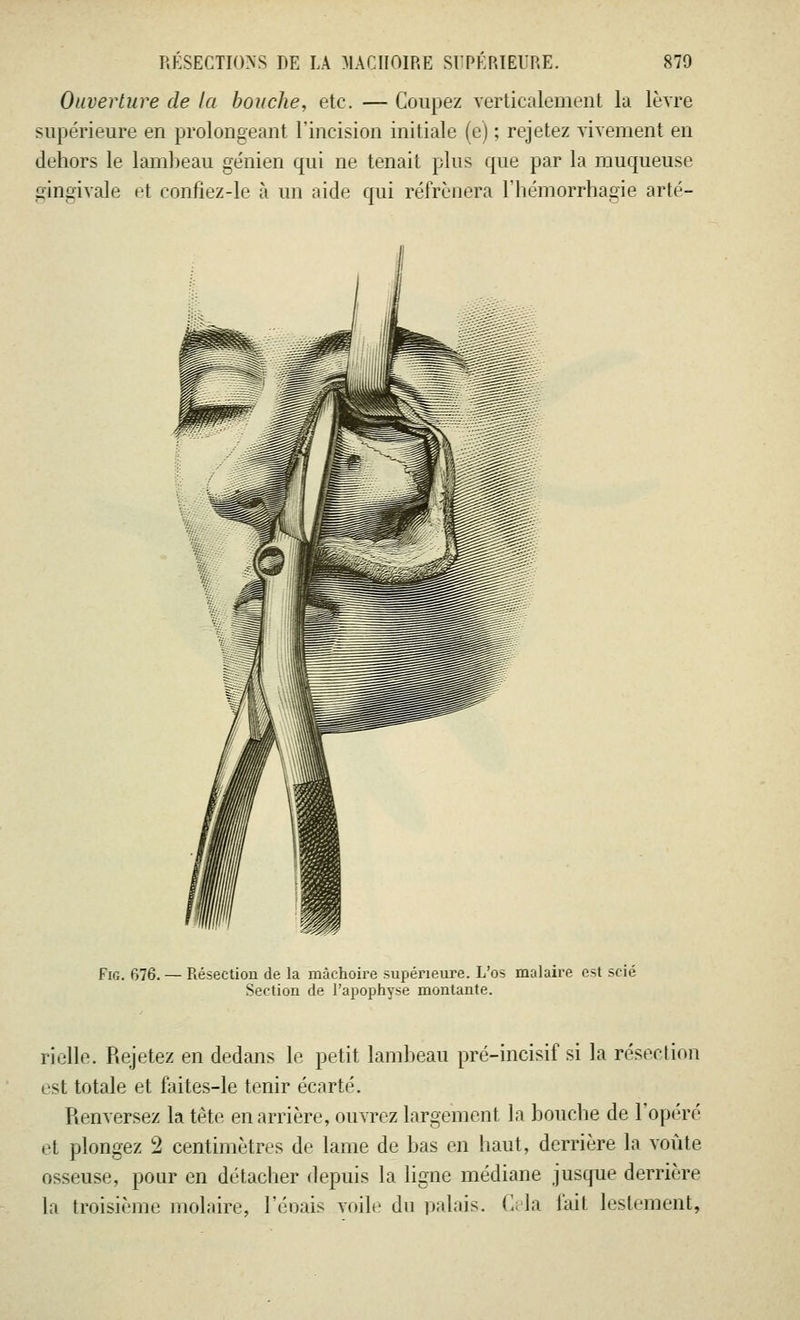 Ouverture de la bouche, etc. — Coupez verticalement la lèvre supérieure en prolongeant l'incision initiale (e) ; rejetez vivement en dehors le lambeau génien qui ne tenait plus que par la muqueuse gingivale et confiez-le à un aide qui réfrénera l'hémorrhagie arté- Fig. 676. — Résection de la mâchoire supérieure. L'os malaire, est scié Section de l'apophyse montante. rielle. Rejetez en dedans le petit lambeau pré-incisif si la résection est totale et faites-le tenir écarté. Renversez la tête en arrière, ouvrez largement la bouche de l'opéré et plongez 2 centimètres de lame de bas en haut, derrière la voûte osseuse, pour en détacher depuis la ligne médiane jusque derrière la troisième molaire, l'éoais voile du palais. Gela l'ail lestement,