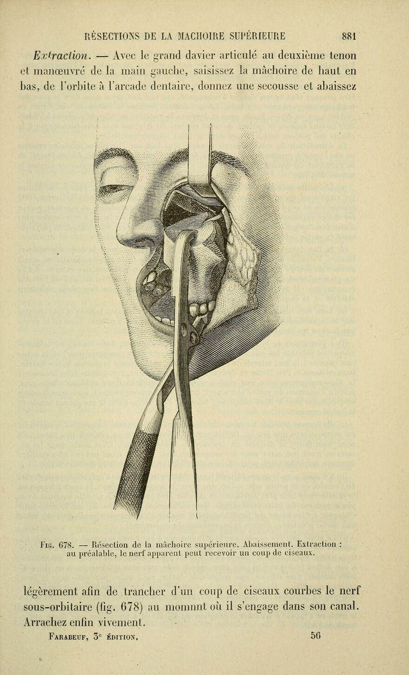 Extraction. — Avec le grand davier articulé au deuxième tenon et manœuvré de la main gauche, saisissez la mâchoire de haut en has, de l'orbite à l'arcade dentaire, donnez une secousse et abaissez Fig. 678. — Résection de la mâchoire supérieure. Abaissement, Extraction : au préalable, le nerf apparent peut recevoir un coup de ciseaux. légèrement afin de trancher d'un coup de ciseaux courbes le nerf sous-orbitaire (t\g. 678) au momnnt où il s'engage dans son canal. Arrachez enfin vivement. Farabeuf, 3e ÉDITION, 50