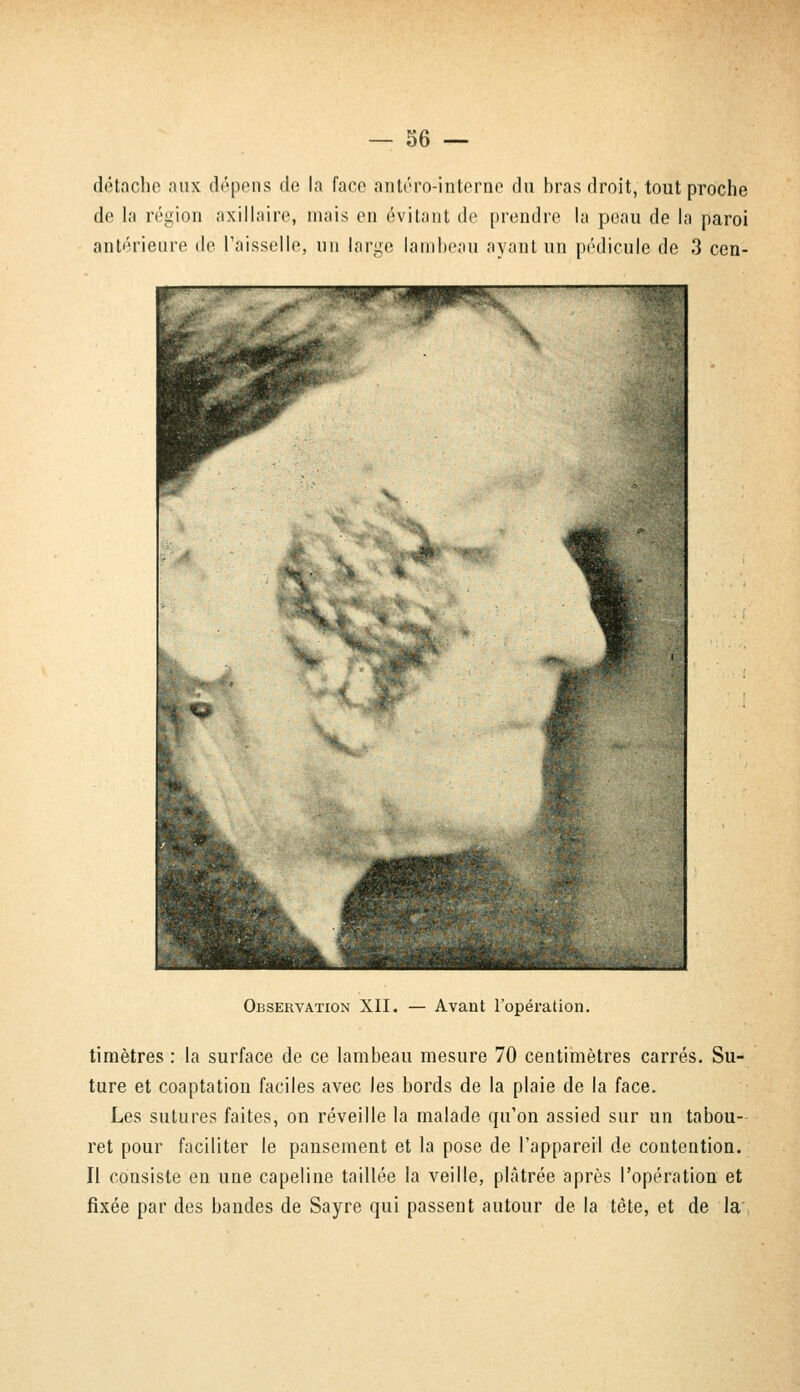 détache aux dépens de la face antéro-interne du bras droit, tout proche de la région axillaire, mais en évitant de prendre la peau de la paroi antérieure de Faisselle, un large lambeau ayant un pédicule de 3 cen- Observation XII. — Avant l'opération. timètres : la surface de ce lambeau mesure 70 centimètres carrés. Su- ture et coaptation faciles avec les bords de la plaie de la face. Les sutures faites, on réveille la malade qu'on assied sur un tabou- ret pour faciliter le pansement et la pose de l'appareil de contention. Il consiste en une capeline taillée la veille, plâtrée après l'opération et fixée par des bandes de Sayre qui passent autour de la tète, et de la'