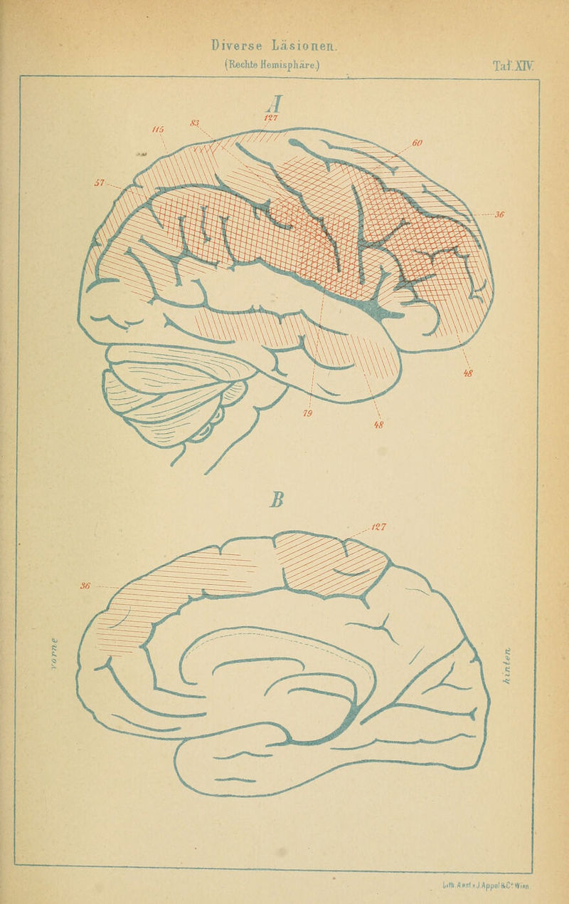 Diverse Läsionen. (Reclite Hemisphäre.) Taf.XIV: l,.ft./(»sf.»,/.AppBl&C':Wi>n