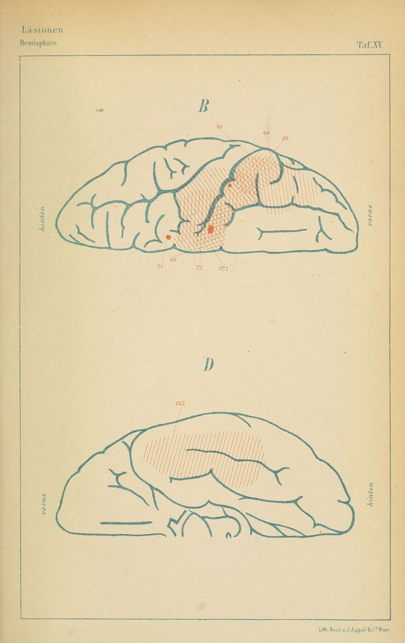 LäsioruMi Hemisphäre TaLW. Li«i Ansl v.J.Appel ü-CnVien