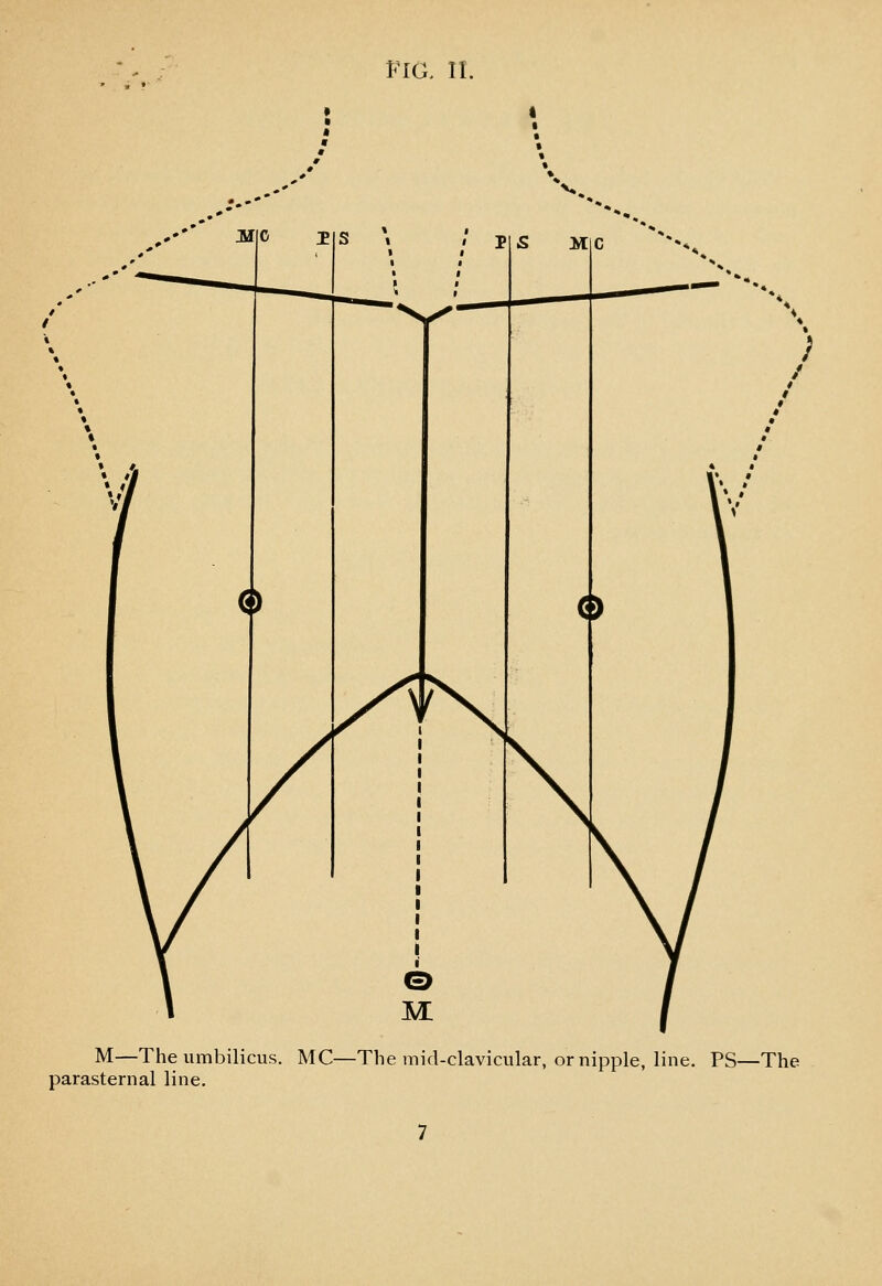 Fia 11. M—The umbilicus. MC—The mid-clavicular, or nipple, line. PS—The parasternal line.