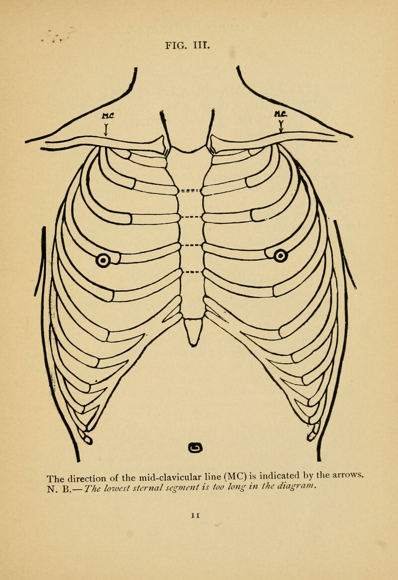 The direction of the mid-clavicular line (MC) is indicated by the arrows. N. B.— T/ie loivest sternal segmetit is too long in the diagram.