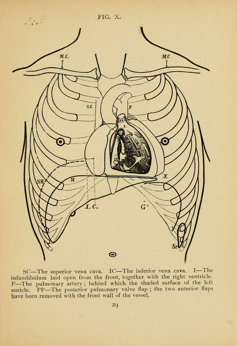 SC—The superior vena cava. IC—The inferior vena cara. I—The infundibulum laid open from the front, together with the right ventricle. P—The pulmonary artery ; behind which the shaded surface of the left auricle. PP—The posterior pulmonary valve flap ; the two anterior flaps have been removed with the front wall of the vessel.