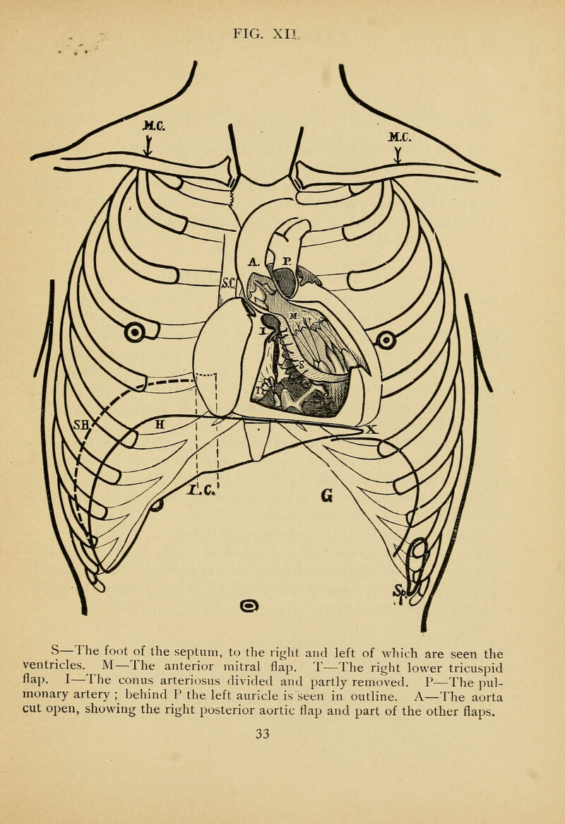 S—The foot of the septum, to the right and left of which are seen the Ventricles.^ M—The anterior mitral flap. T—The right lower tricuspid flap. I—The conus arteriosus divided and partly removed. P—The pul- monary artery ; behind P the left auricle is seen in outline. A—The aorta cut open, showing the right posterior aortic flap and part of the other flaps.