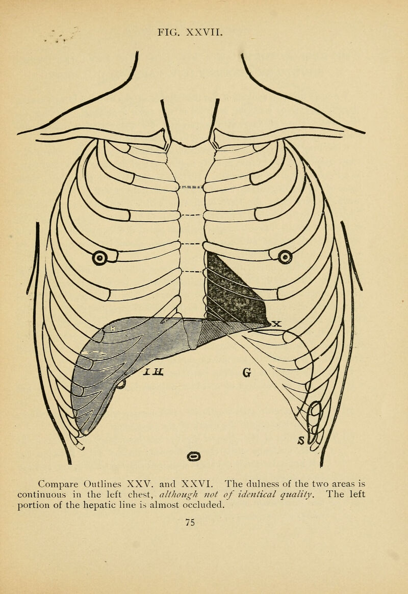 Compare Outlines XXV. and XXVI. The dulness of the two areas is continuous in the left chest, although not of identical qtiality. The left portion of the hepatic line is almost occluded.